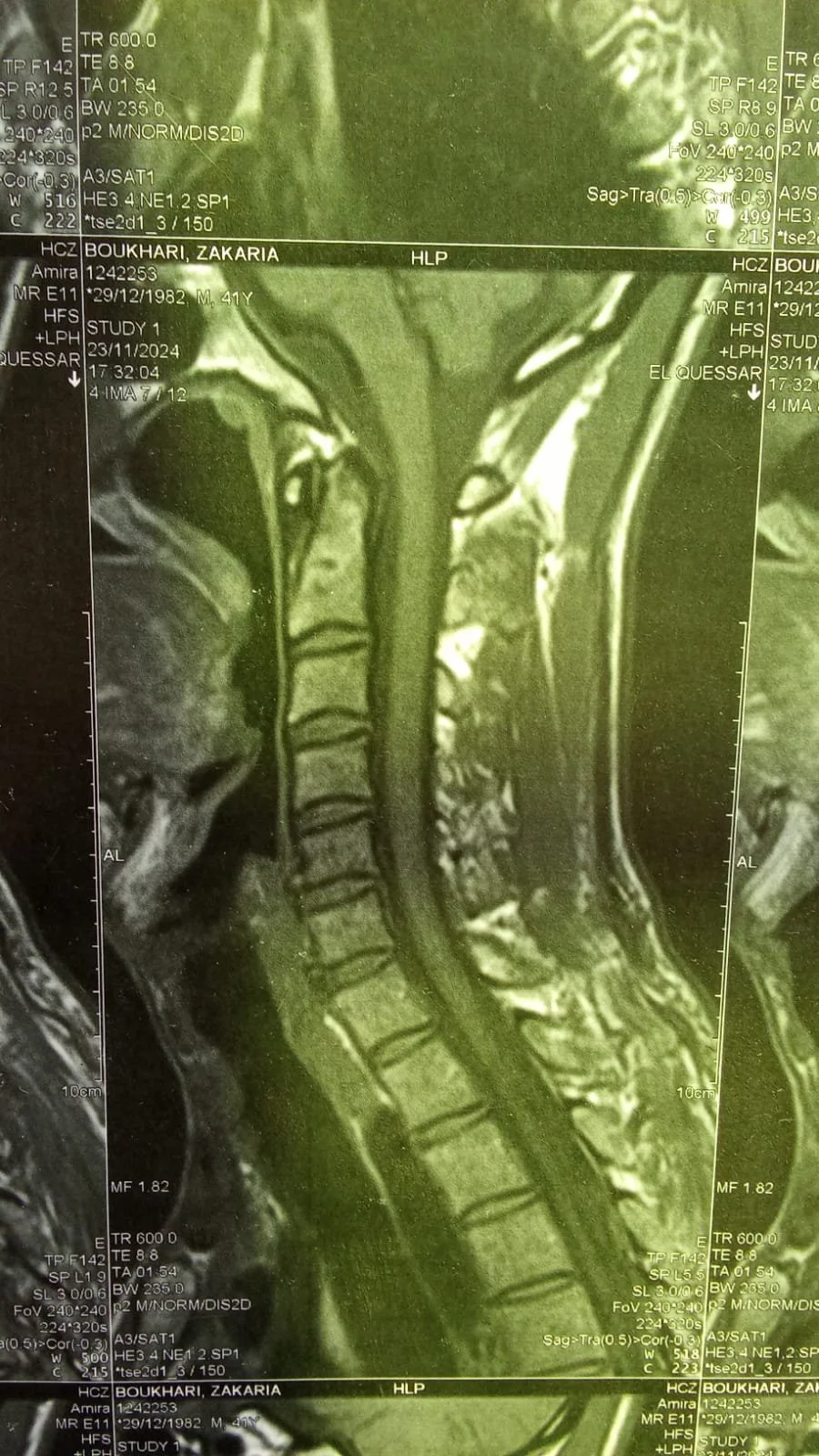 MRI scan image showing a side view of a human neck and spinal cord.