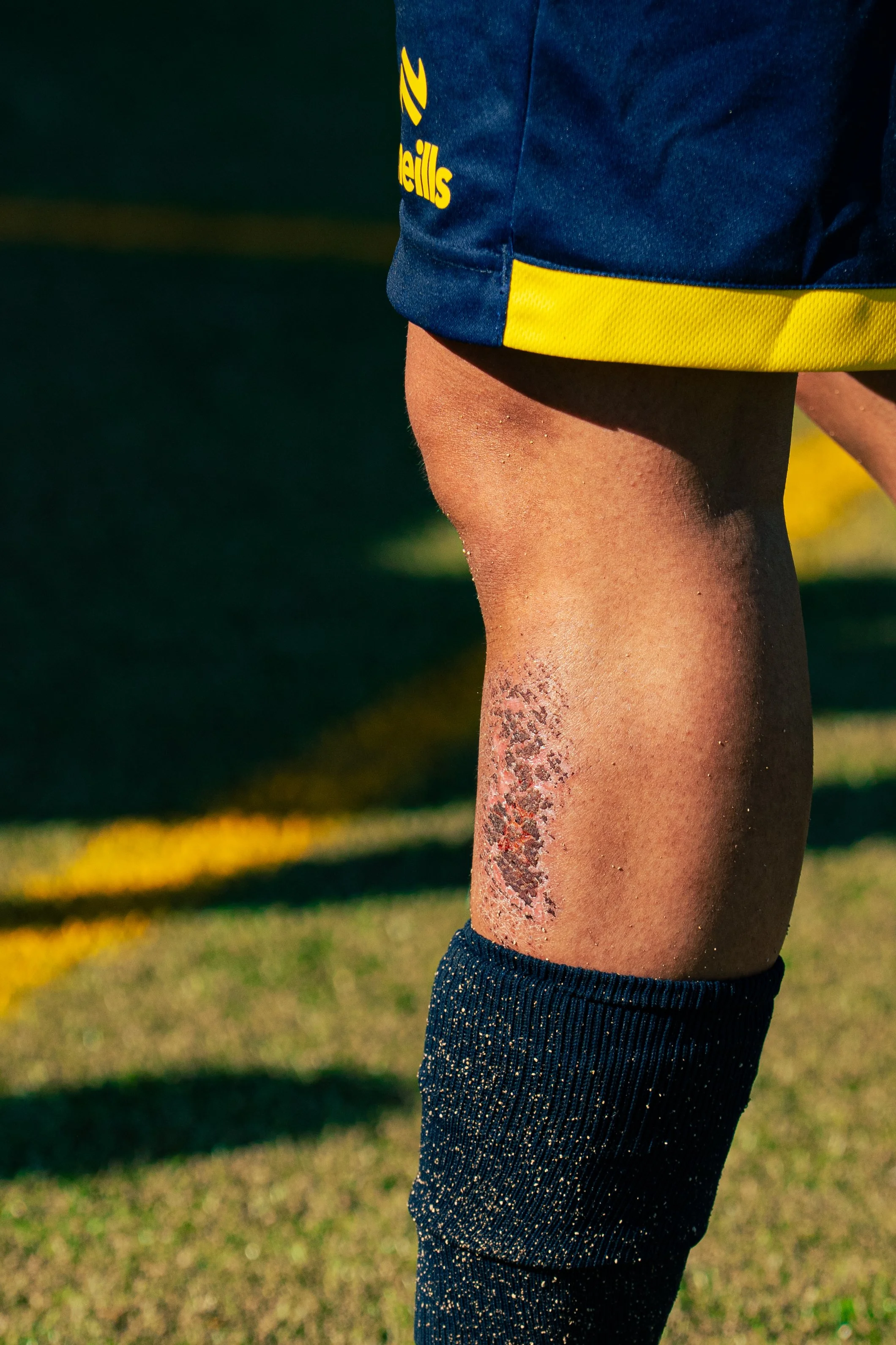 Close-up of a person's midsection and leg, showing a large scar or burn injury on the thigh, wearing a blue and yellow sports uniform.