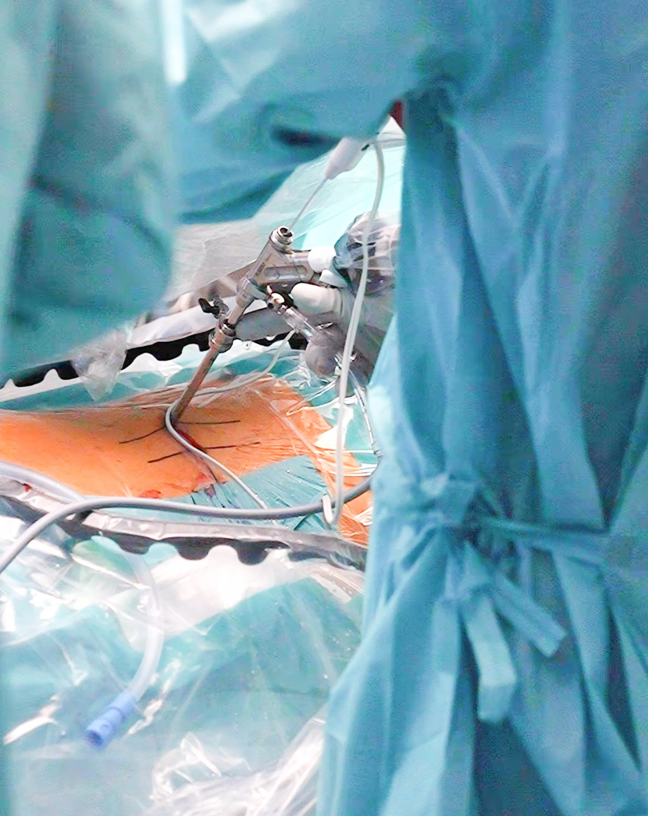 Blick in einen Operationssaal während einer Operation, umgeben von Ärzten in blauen OP-Kleidern, mit chirurgischen Instrumenten und medizinischer Ausrüstung.