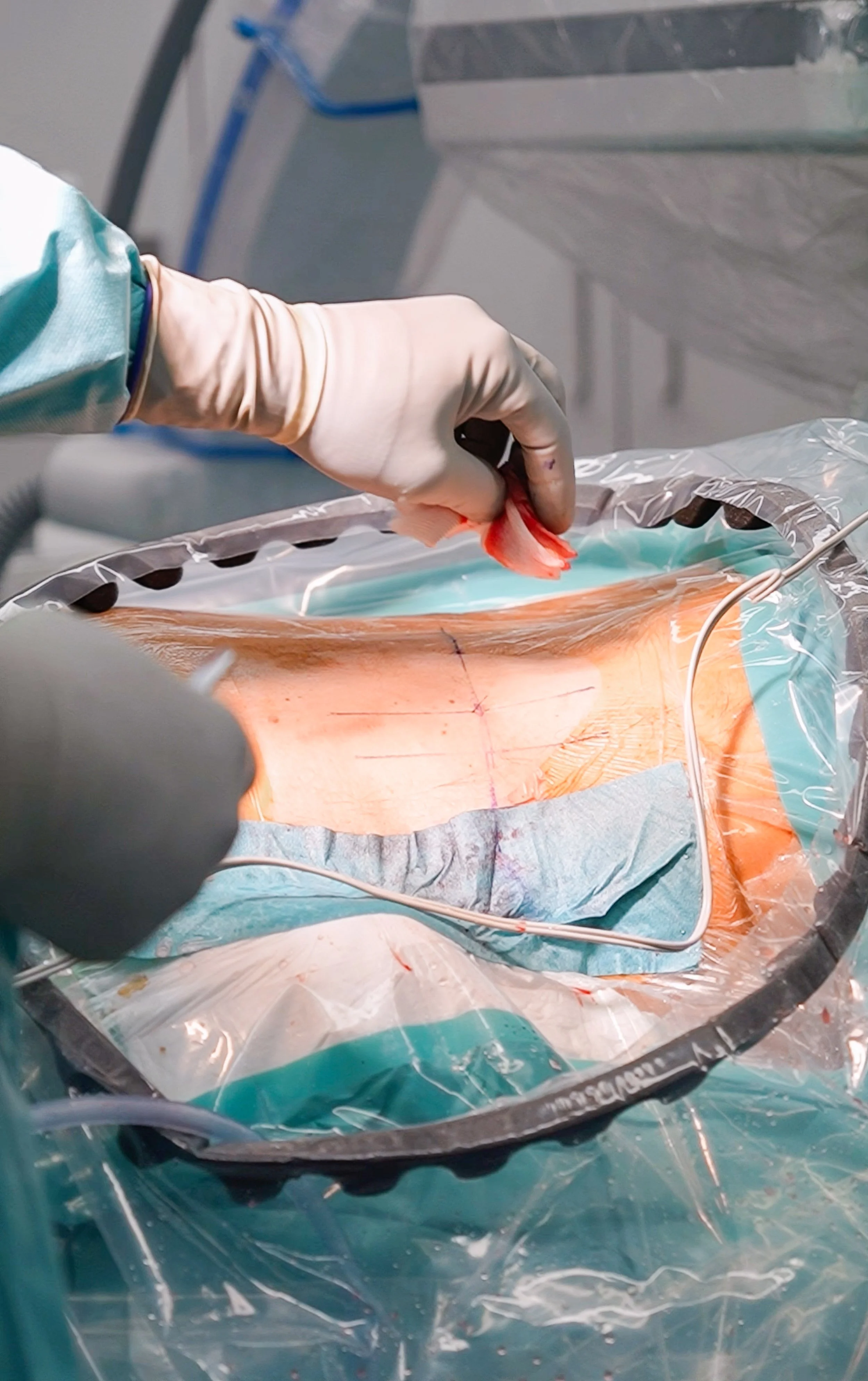 Chirurg bei Operation mit sterilem Handschuh, operiert am offenen Bauch eines Patienten, in einem Operationssaal.