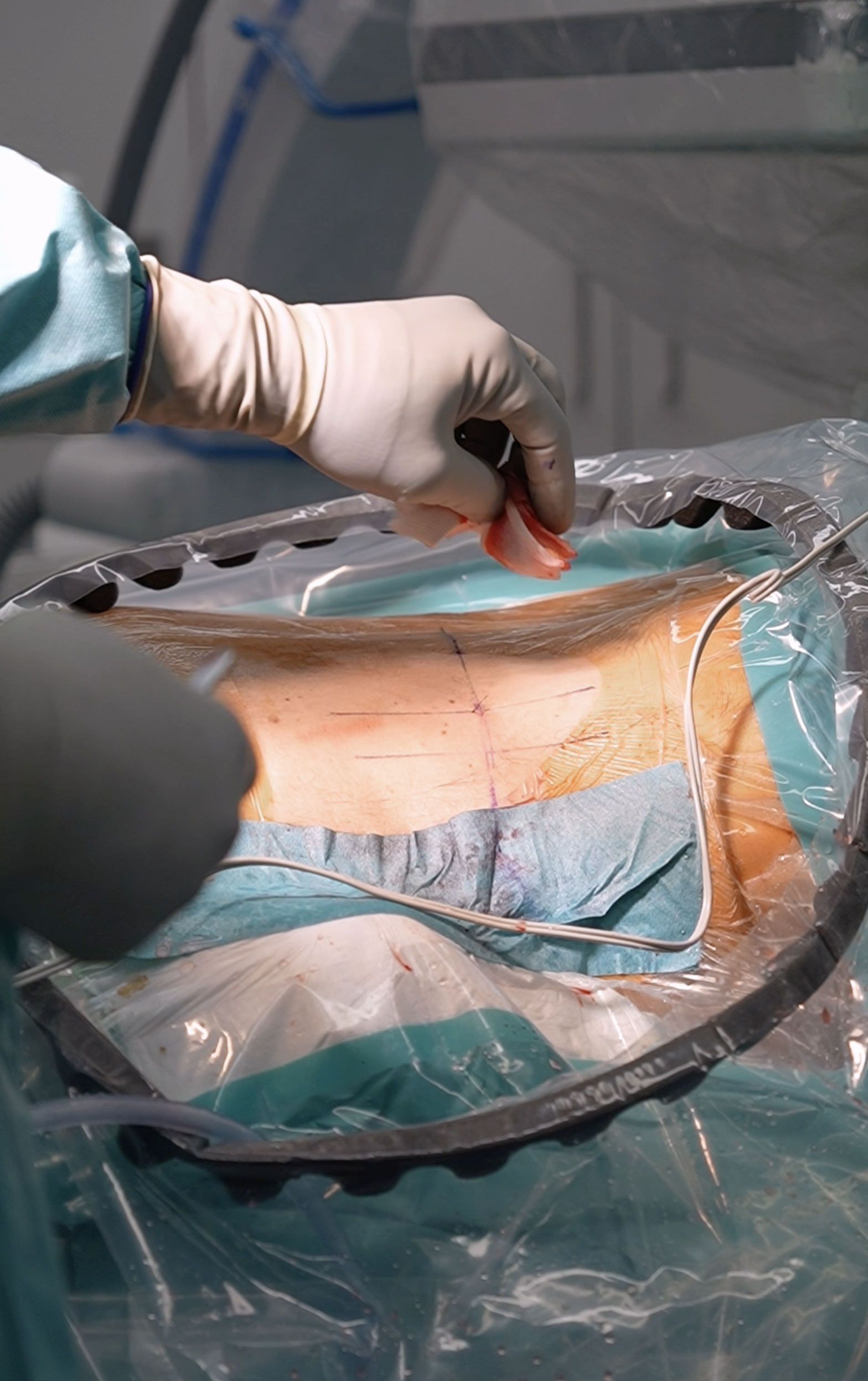 Ein Arzt oder Chirurg im OP untersucht einen Patienten, der auf dem OP-Tisch liegt, mit einem blauen OP-Kittel, Handschuhen und einer Schutzmaske. Die Operationswunde ist sichtbar und wird möglicherweise genäht oder behandelt.