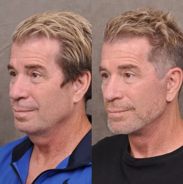 Tech Bro Face Lift