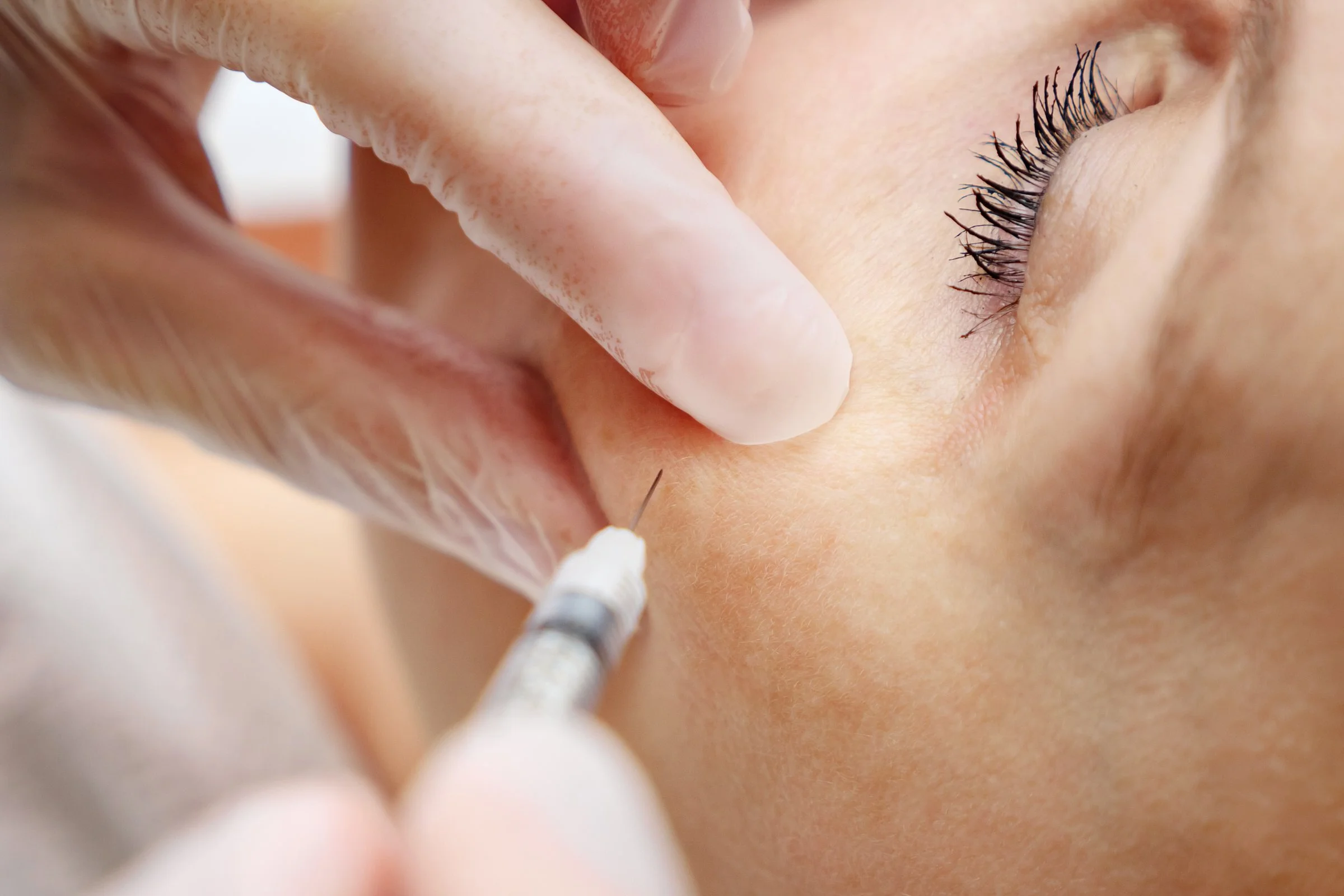 A close-up of a person receiving a cosmetic injection near their eye, with a gloved hand holding the syringe.