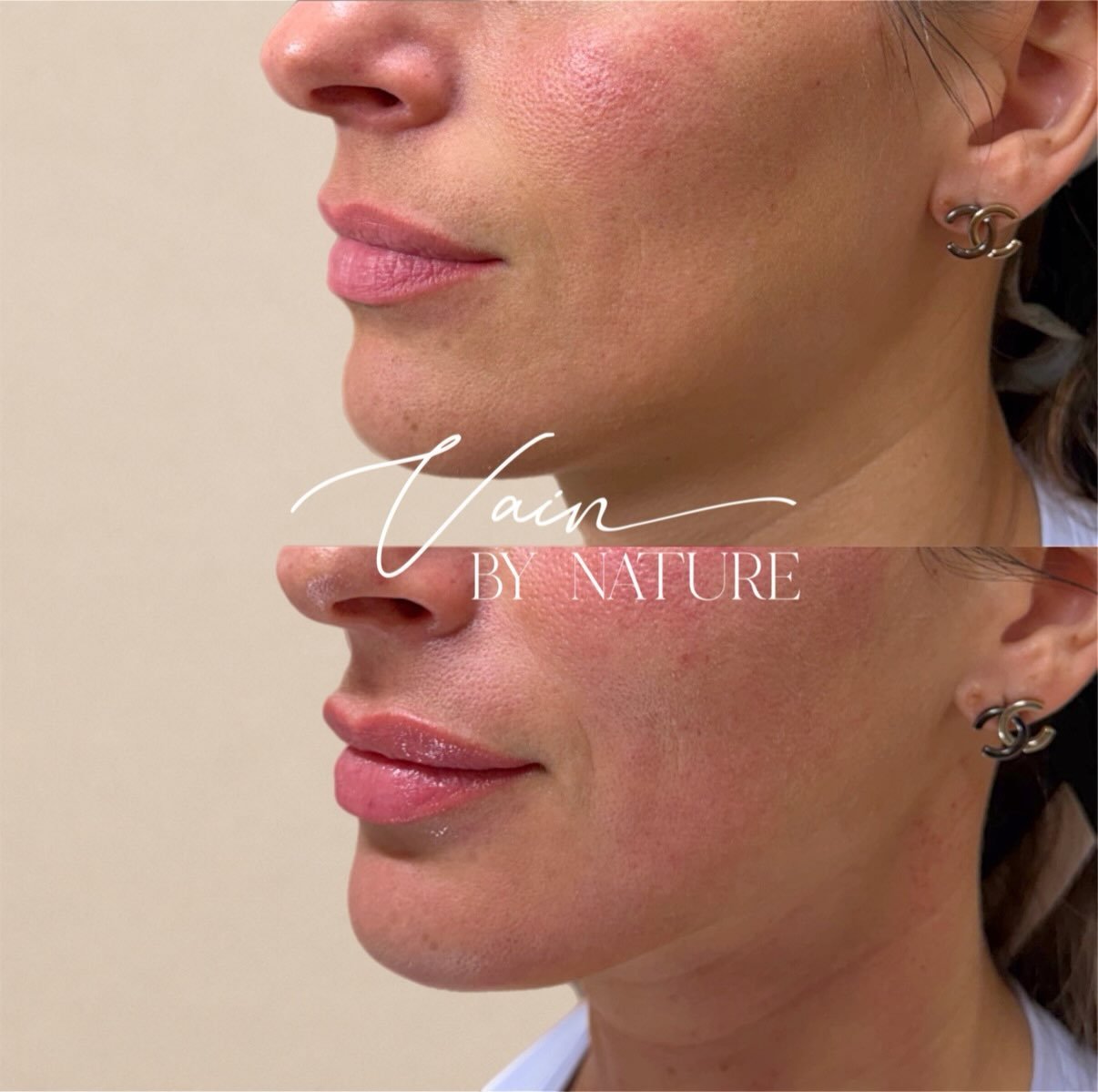 In need of a little refresh? 

A little lip filler and a microneedling treatment might be just what you need. 😌

#LipFiller #Microneedling #AestheticInjectables #LipEnhancement #VBNAesthetics
A fresh boost, a little glow, and that refreshed feeling 