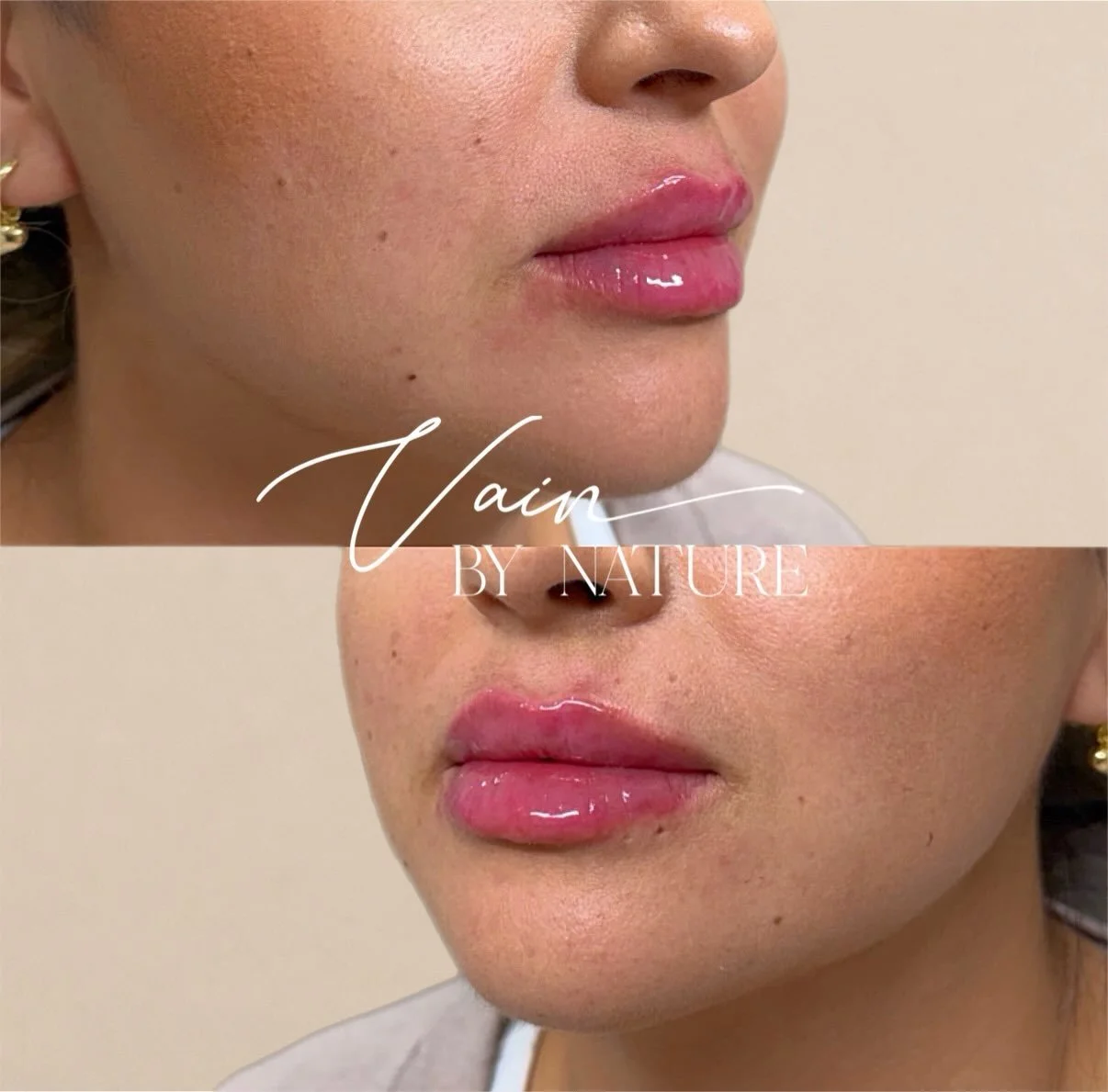 A refined lip enhancement designed to complement her natural features. 💋

#LipFiller #LipEnhancement #LipInjections #AestheticInjector #VBNAesthetics