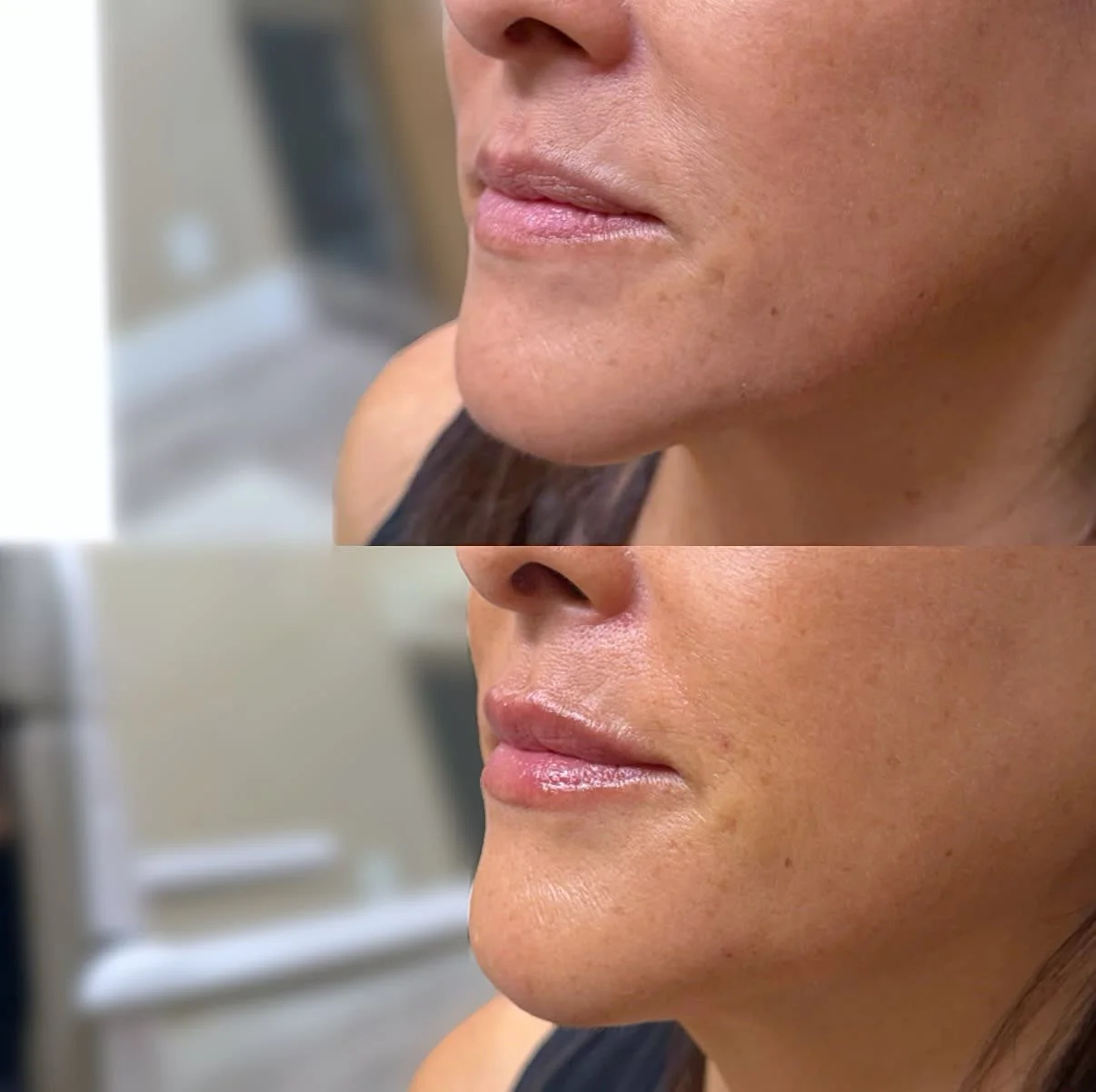 Before and after results from Vain by Nature Aesthetics in Rancho Cucamonga, CA