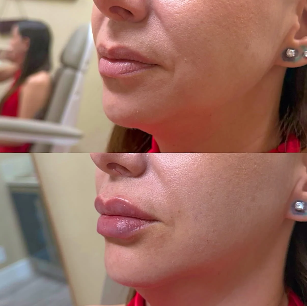 Before and after results from Vain by Nature Aesthetics in Rancho Cucamonga, CA