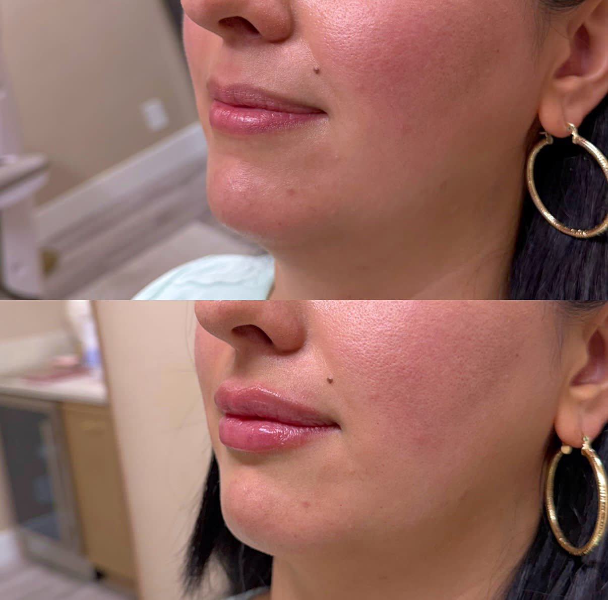 Before and after results from Vain by Nature Aesthetics in Rancho Cucamonga, CA