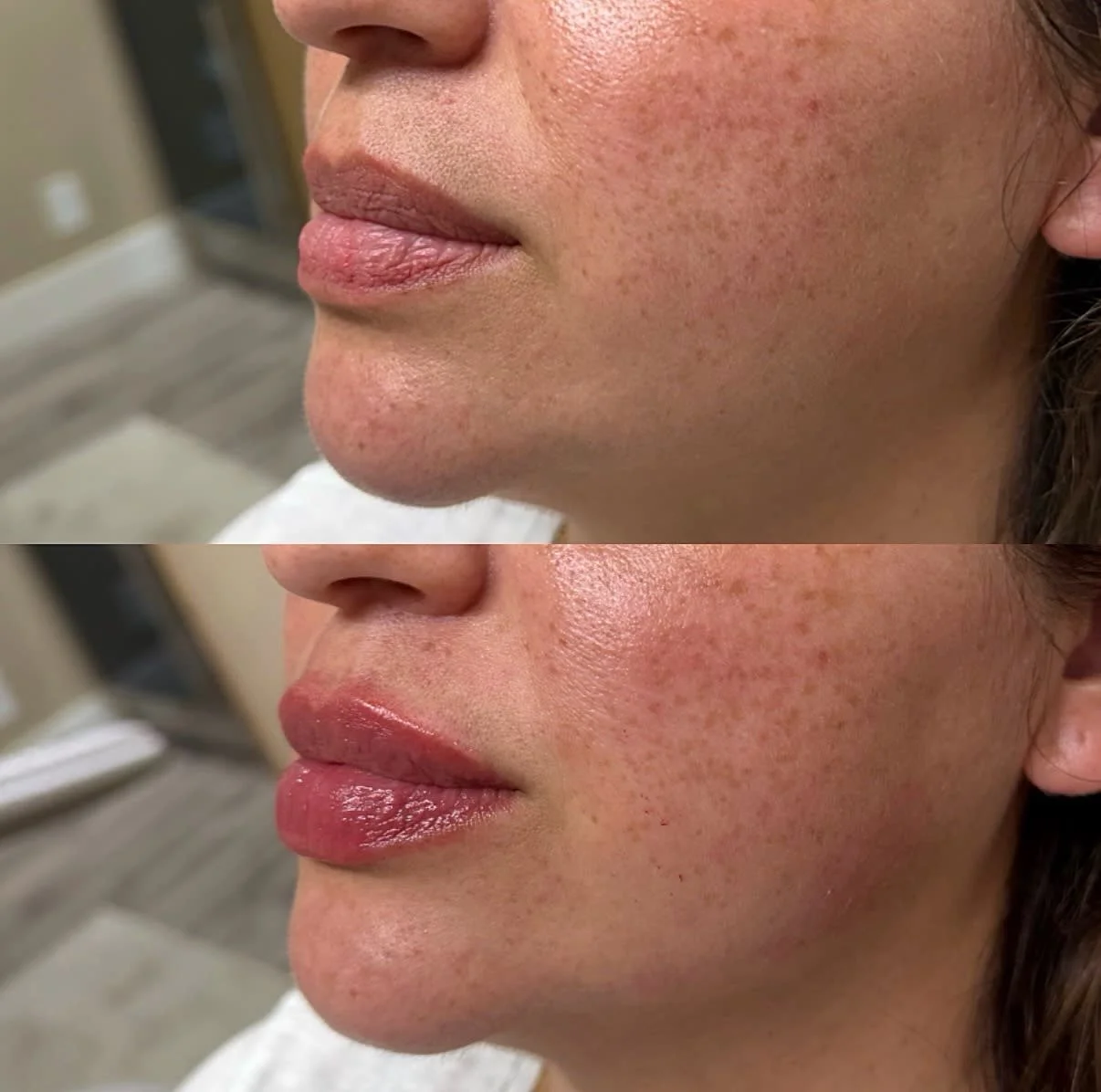 Before and after results from Vain by Nature Aesthetics in Rancho Cucamonga, CA