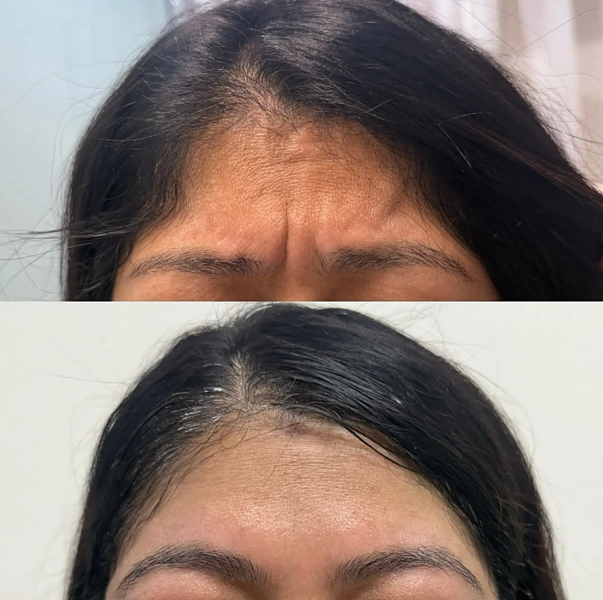 Before and after results from Vain by Nature Aesthetics in Rancho Cucamonga, CA