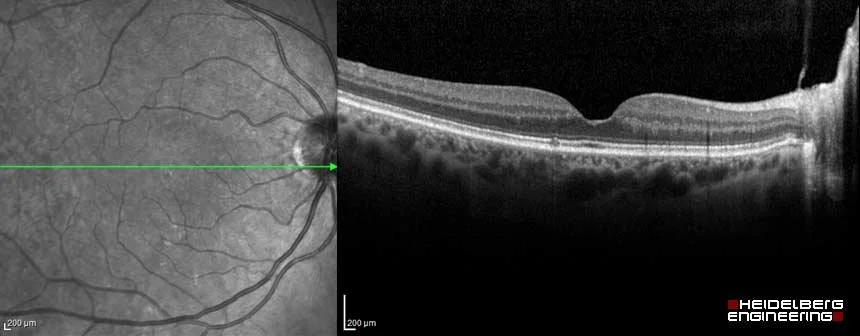 Optical coherence tomography scan of the retina showing layers of the eye's back surface.