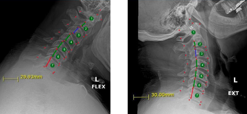 X-ray images of a cervical spine with measurements and markings indicating vertebrae and alignment. The left image shows 7 vertebrae in flexion, and the right shows 7 vertebrae in extension.