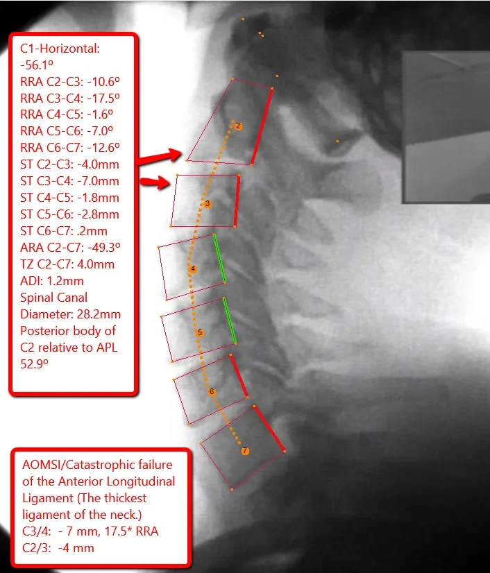 A digital X-ray of a cervical spine with annotations showing measurements and angles related to spinal structures, ossification of the anterior longitudinal ligament and evidence of retropharyngeal calcifications to explain chiropractic care