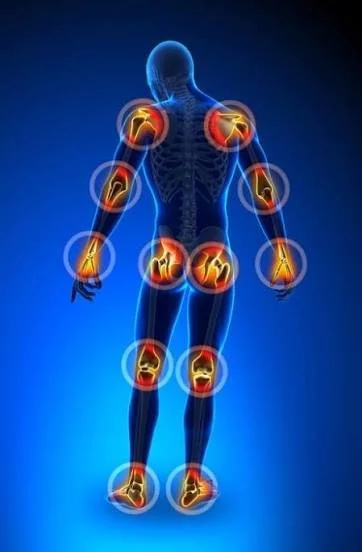 Digital illustration of a human body with highlighted joints indicating areas of joint pain or inflammation, including shoulders, elbows, wrists, hips, knees, and ankles.