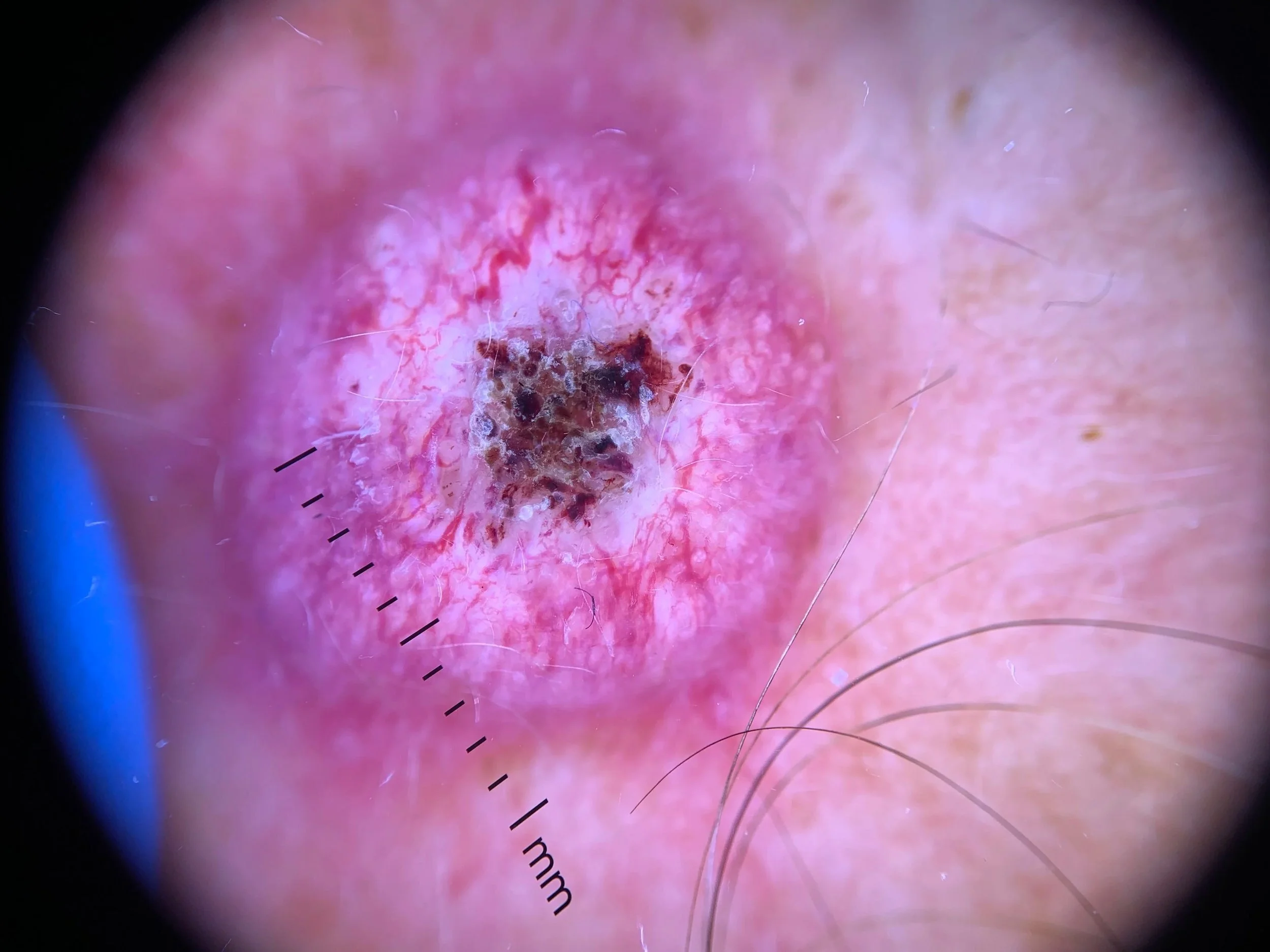 Close-up of a skin lesion or wound with redness, dark scabbing, and surrounding skin irritation, possibly showing signs of infection or injury.