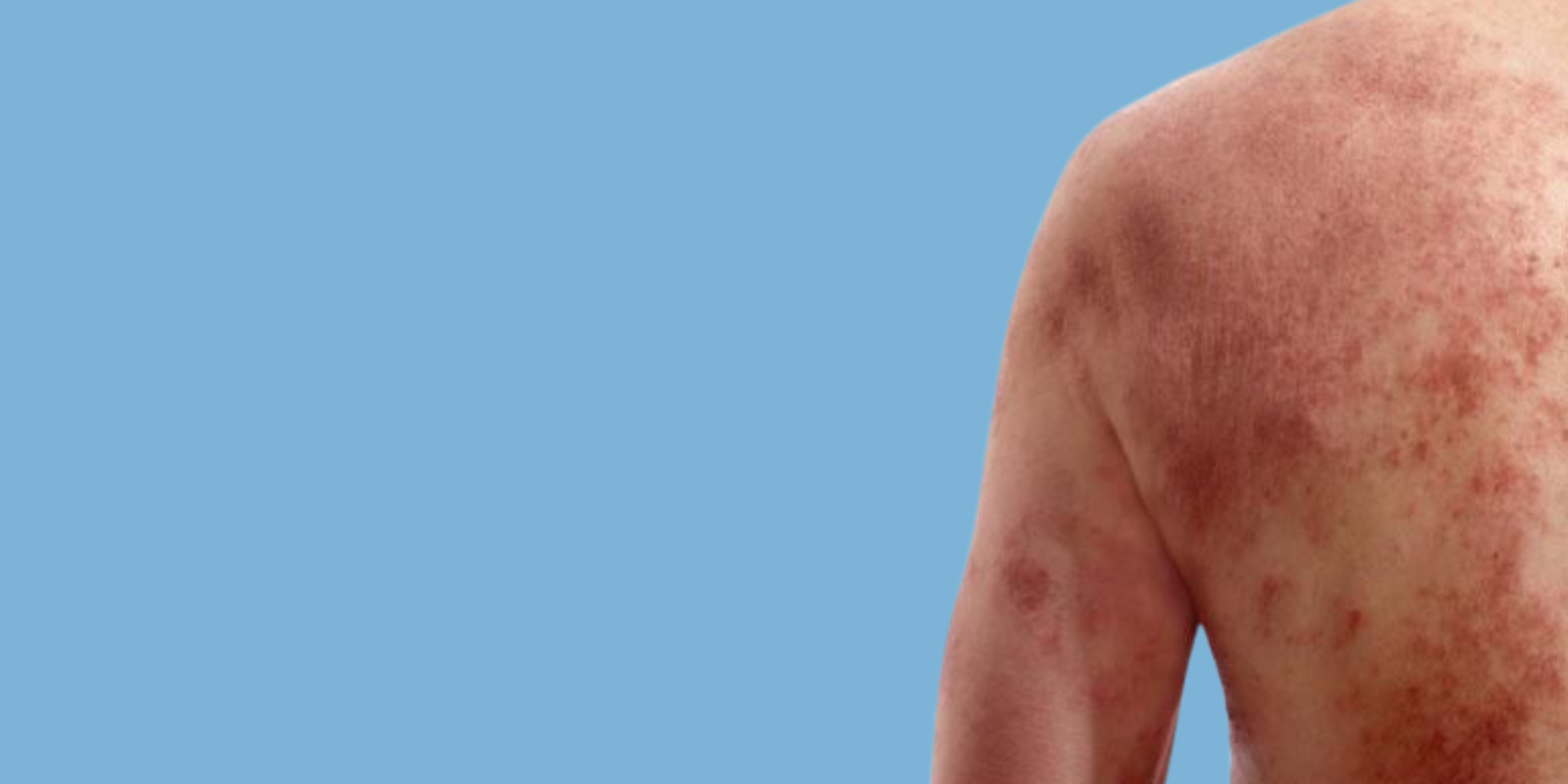 Close-up of a person's shoulder and upper arm with a skin condition characterized by red, inflamed, and scaly patches, against a blue background.