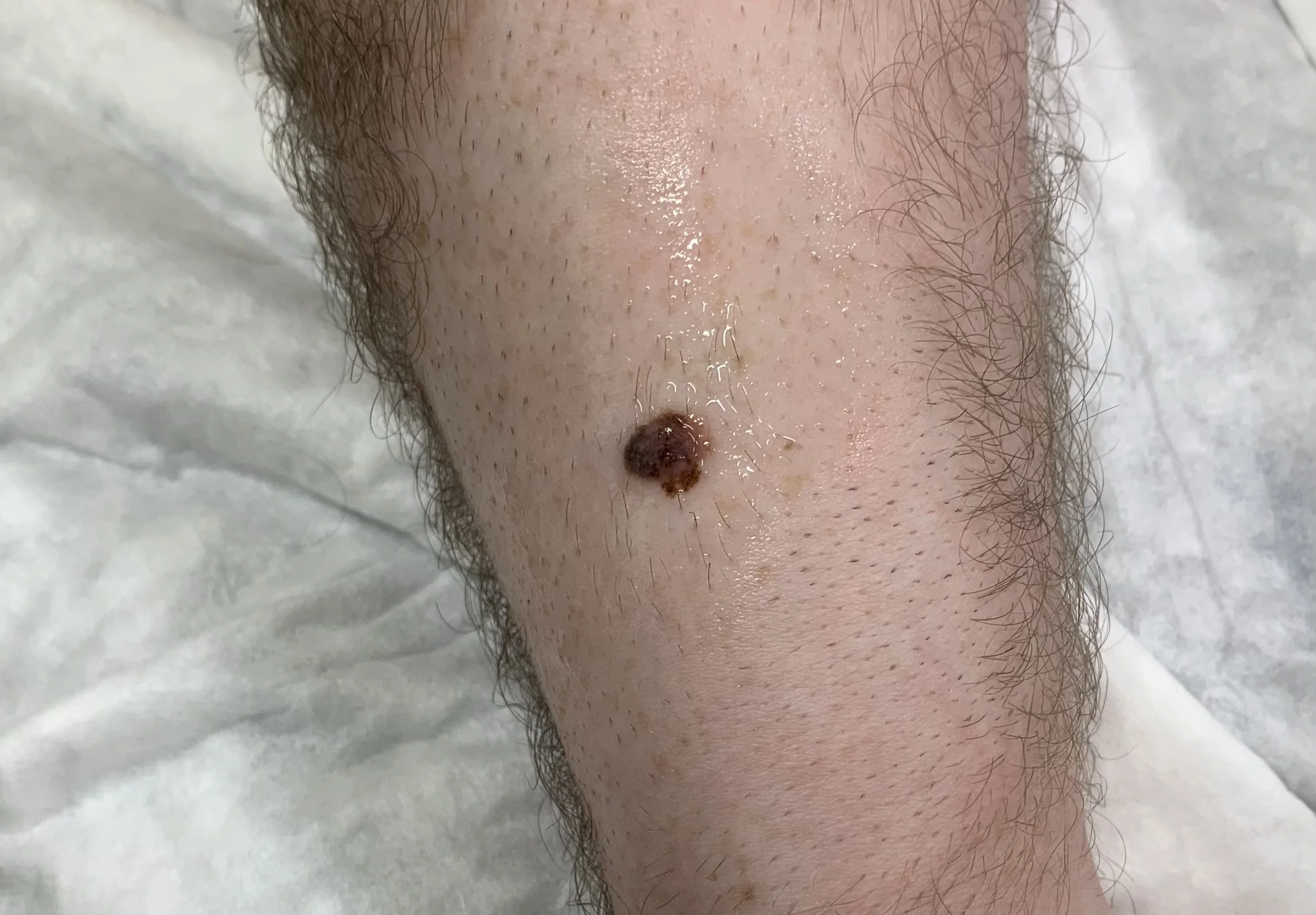 Close-up image of a person's leg with hair and a mole.