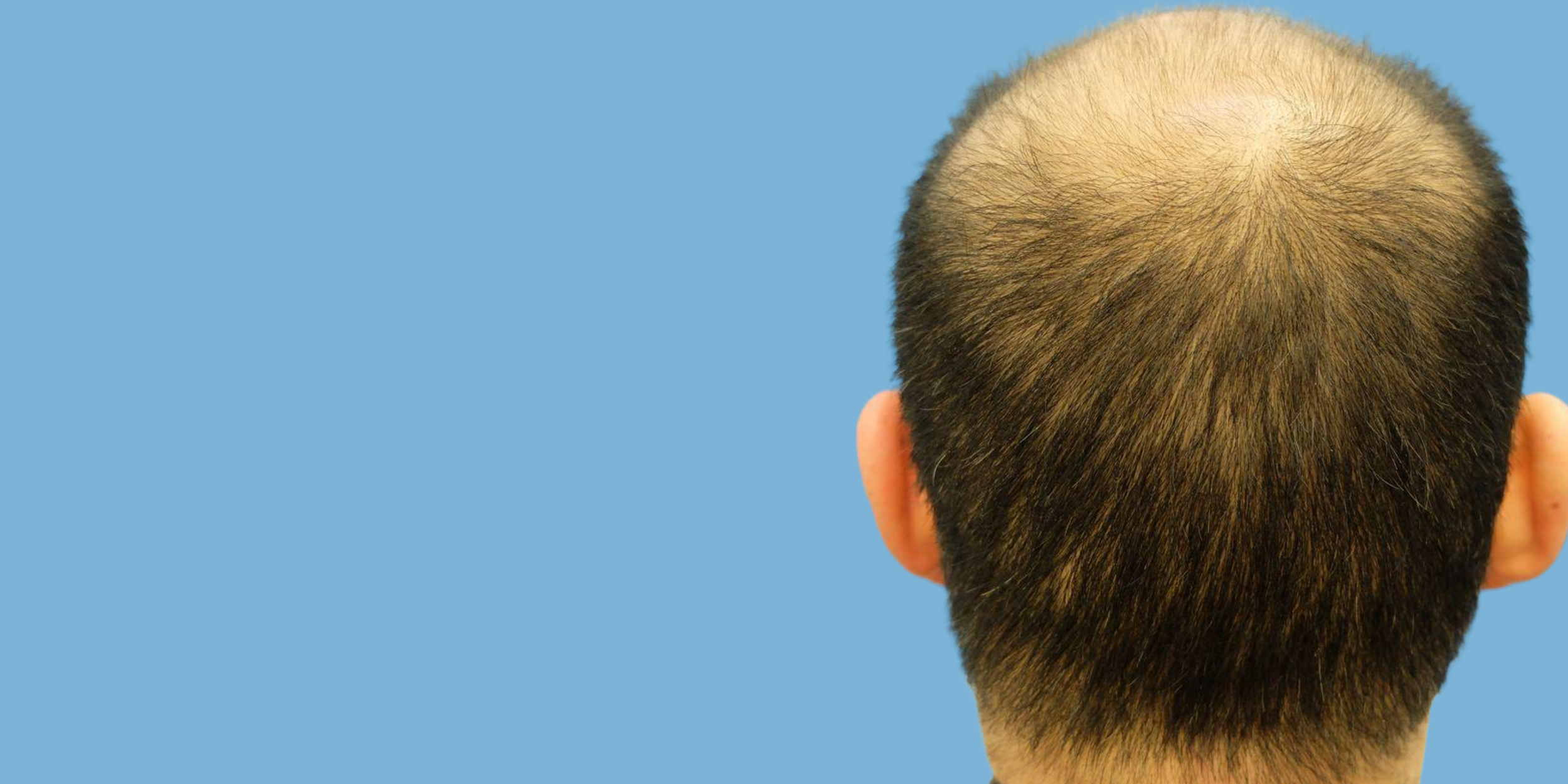 Top view of a person's head with short, dark hair and a bald spot on the crown, against a blue background.