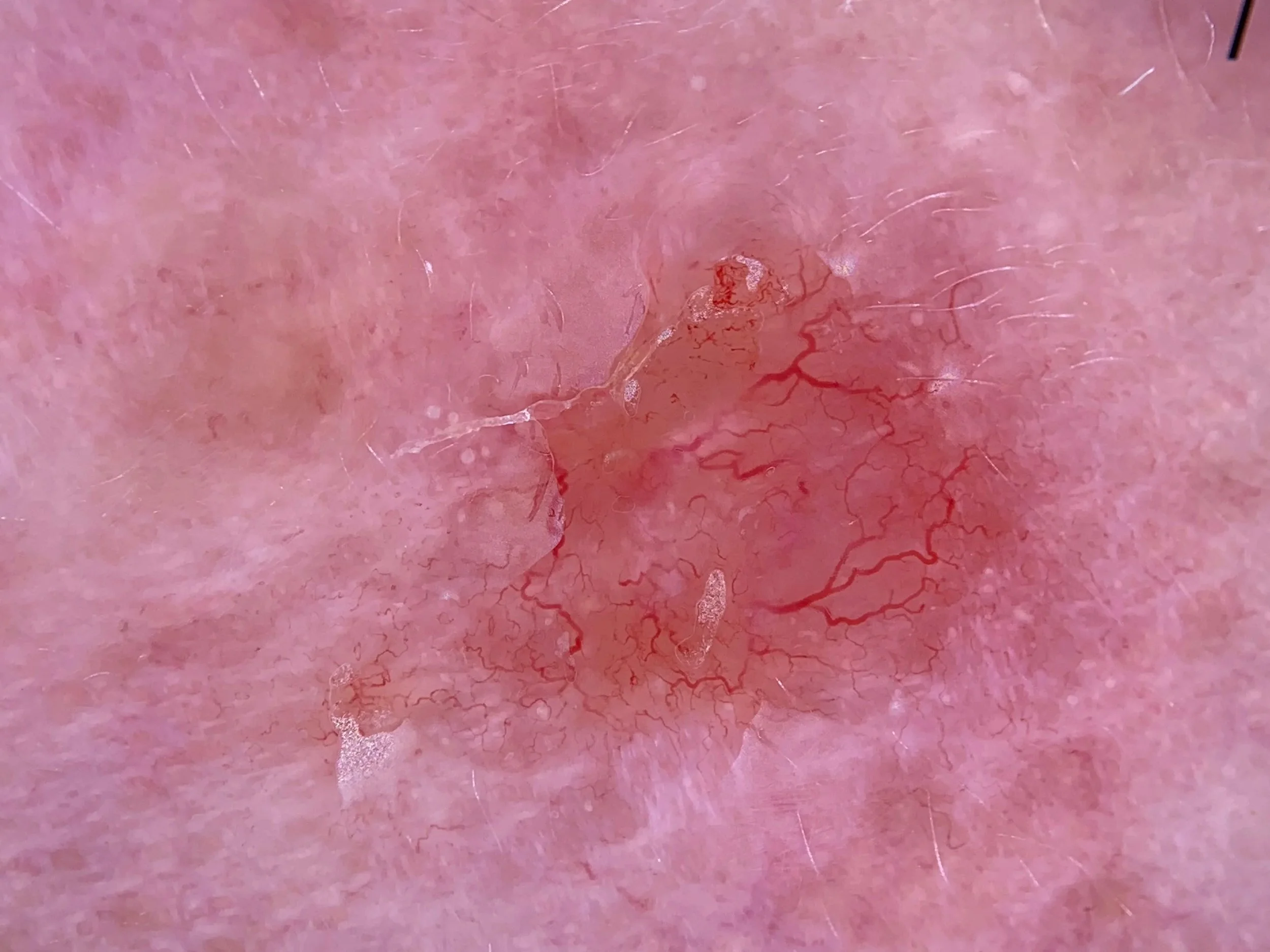 Close-up view of human skin with visible blood vessels, redness, and small blood spots.