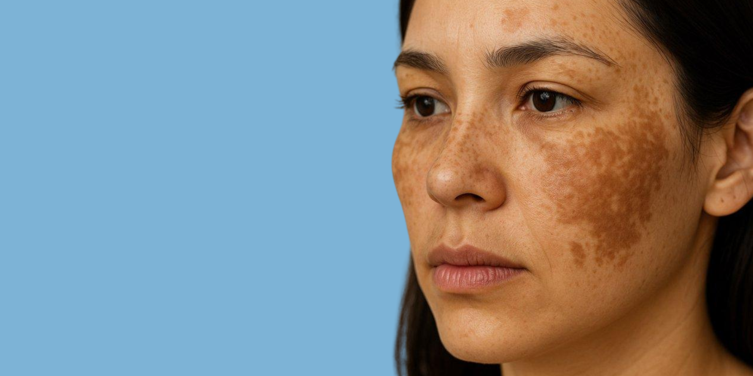 Close-up of a woman with facial freckles and brown hair against a blue background.