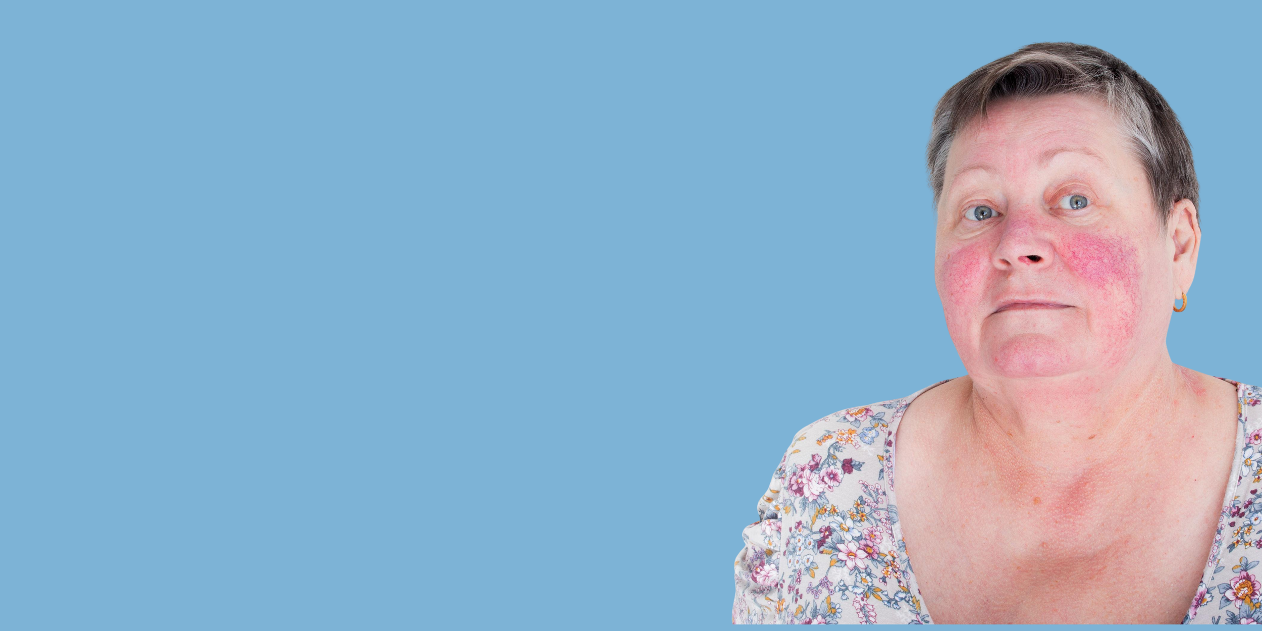 A middle-aged woman with short gray hair and blue eyes, wearing a floral blouse and gold hoop earrings, with red rash on her face and neck, against a solid light blue background.