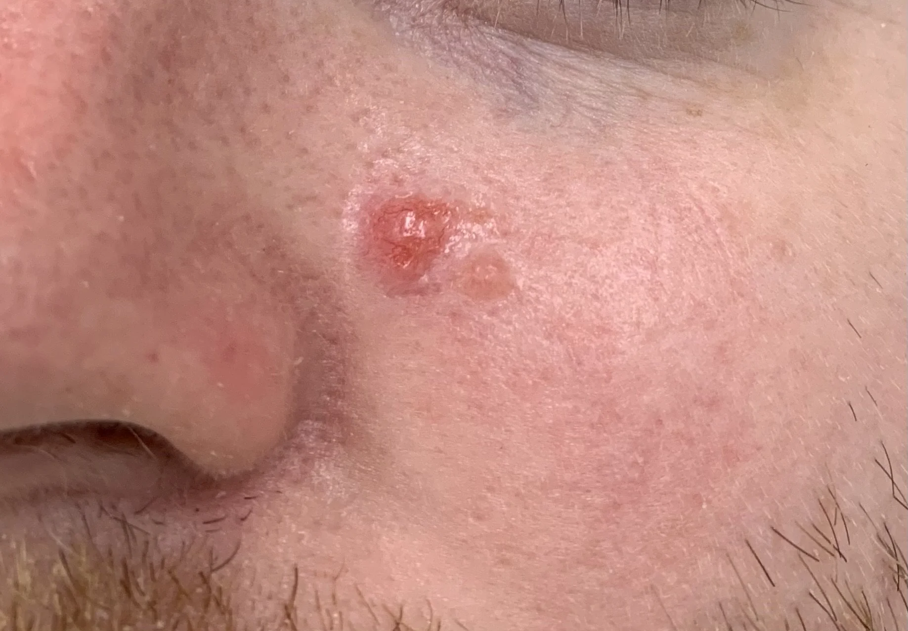 Close-up of a person's nose with a noticeable pimple or bump.