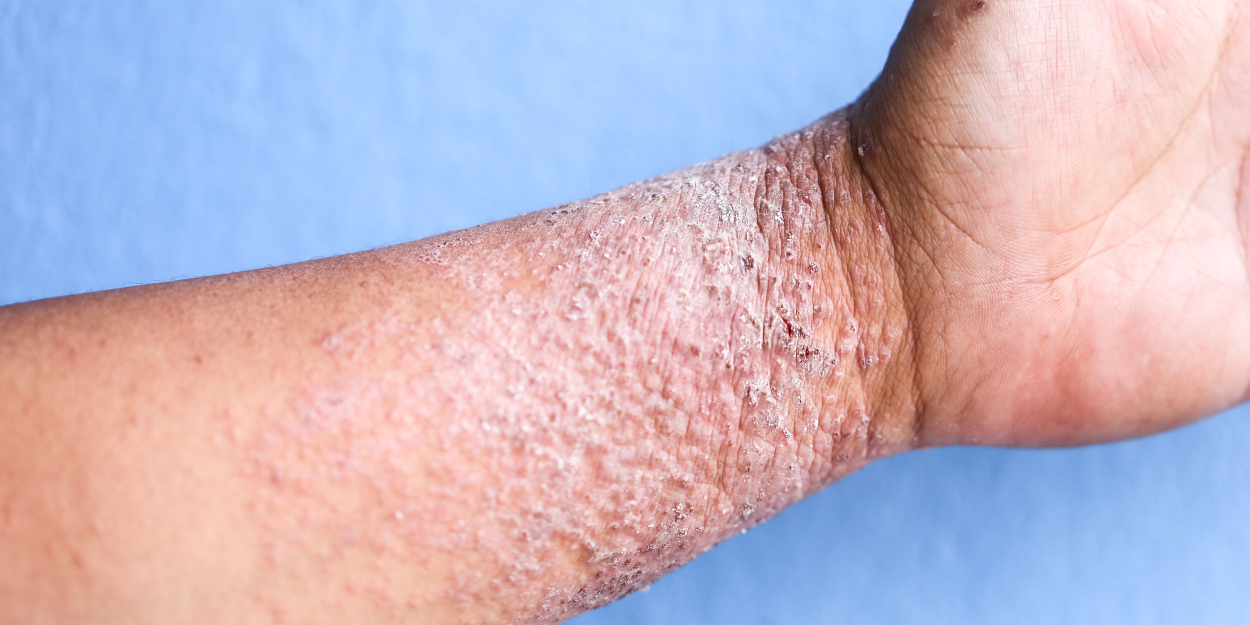 Close-up of an arm with dry, flaky, and peeling skin, likely due to a skin condition or irritation.