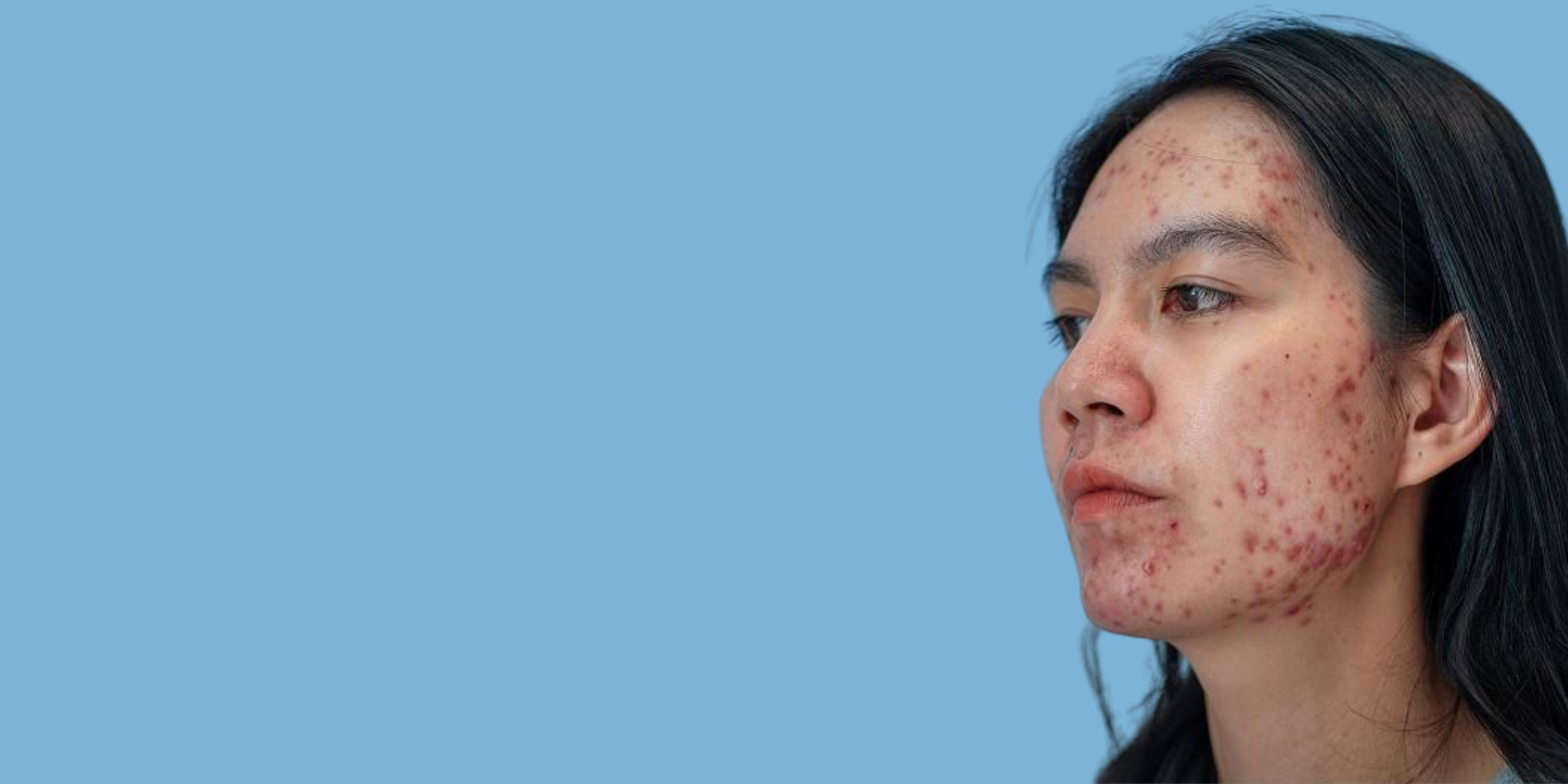 A woman with long black hair looking to the right, with acne on her face and jawline, against a plain light blue background.