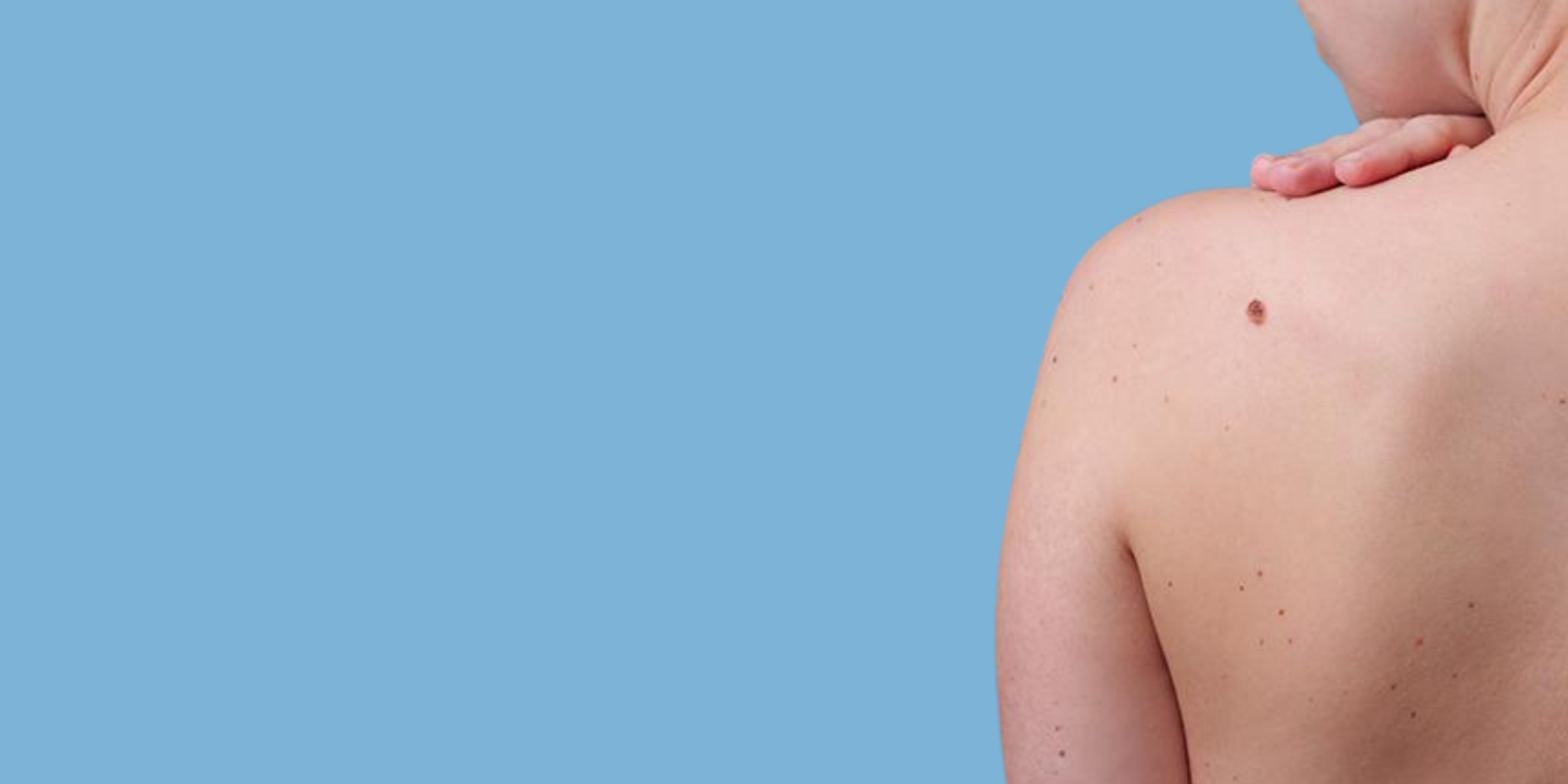 Close-up of a person's shoulder and upper back with a mole on the skin, against a blue background.