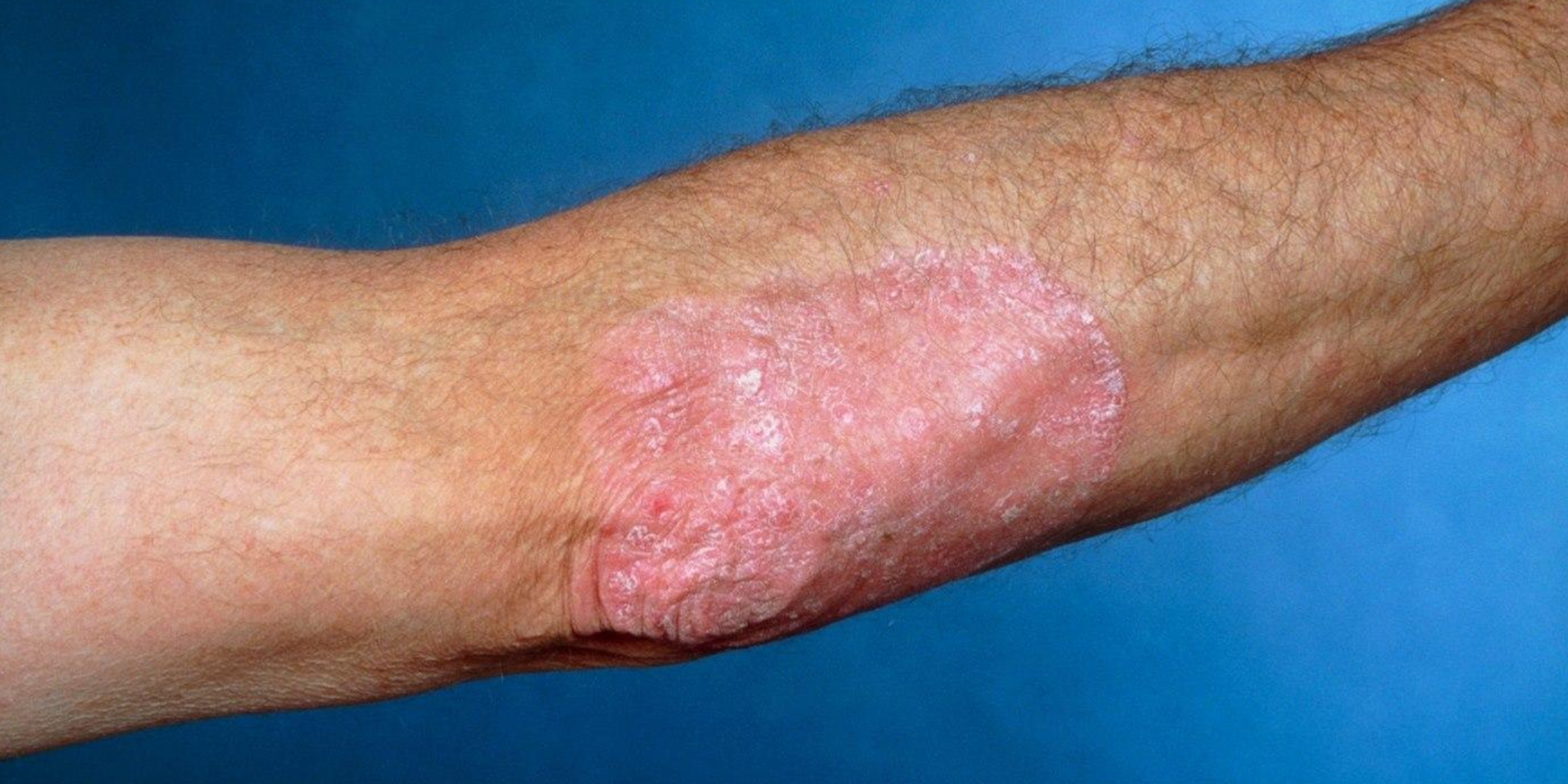 Close-up of an arm with psoriasis, showing red, scaly patches on the skin.