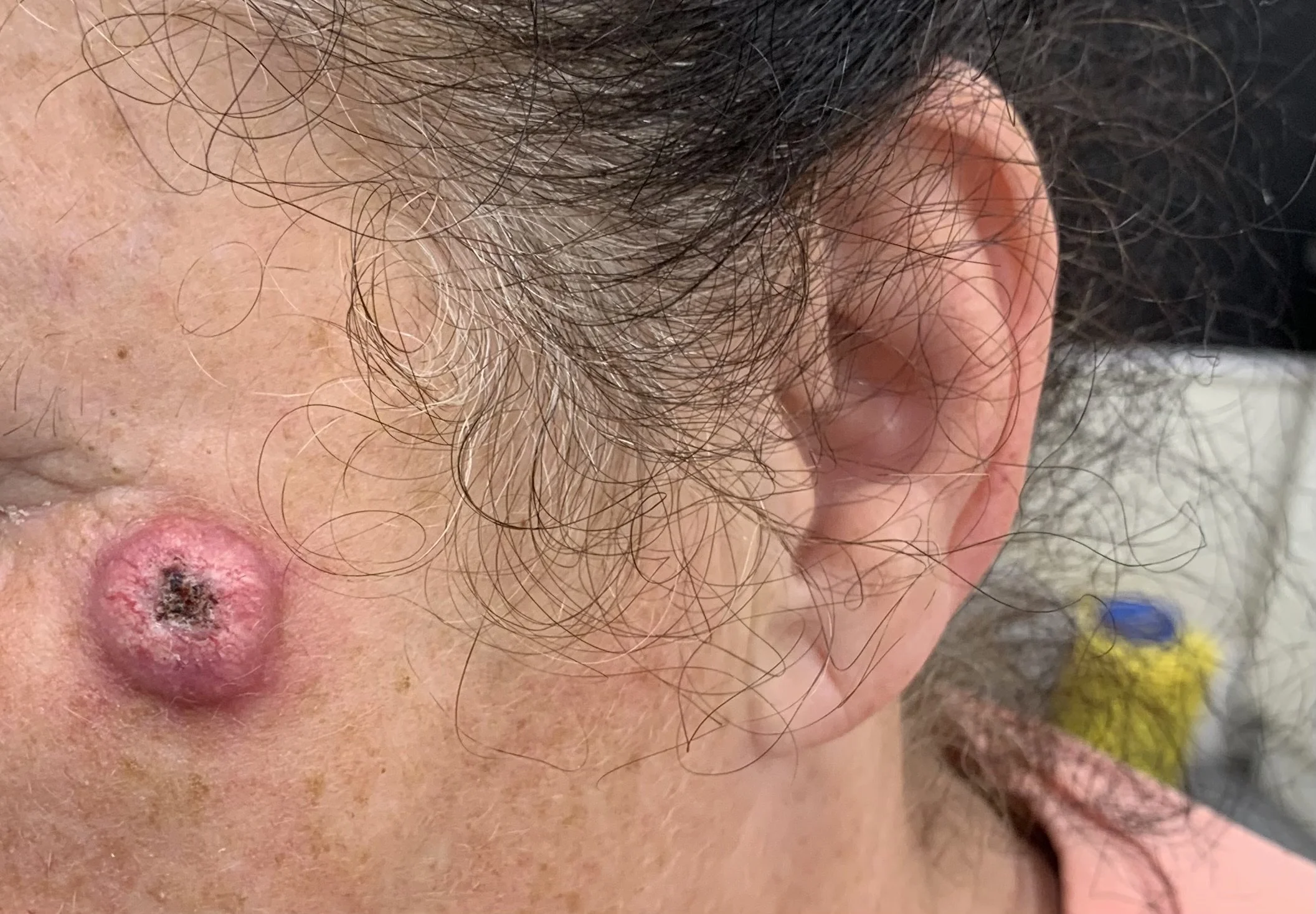 Close-up of a person's left ear, with visible hair, skin texture, and redness around the earlobe. The background shows some colorful objects.