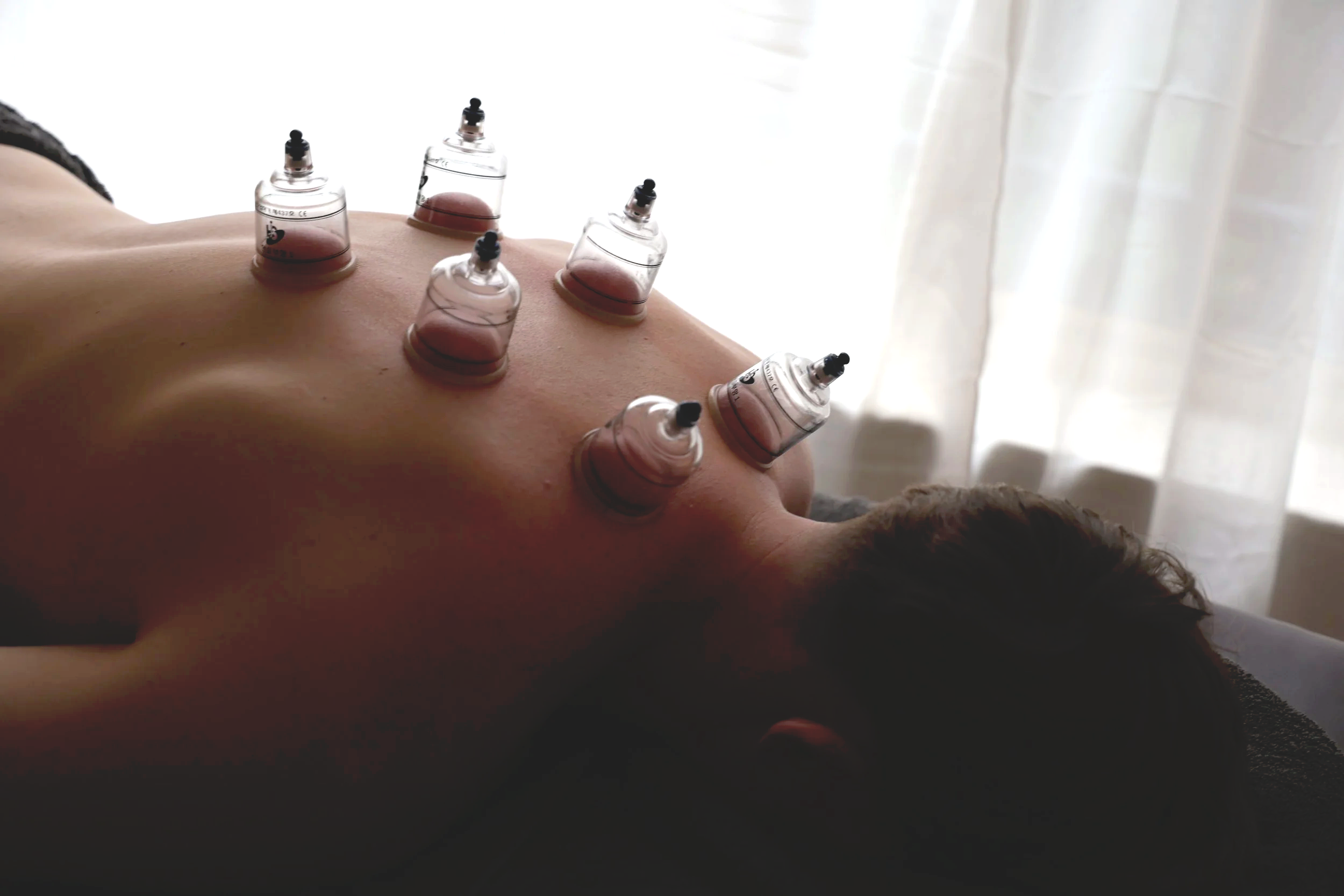 A person lying face down receiving myofascial cupping  treatment with multiple cups on their back.