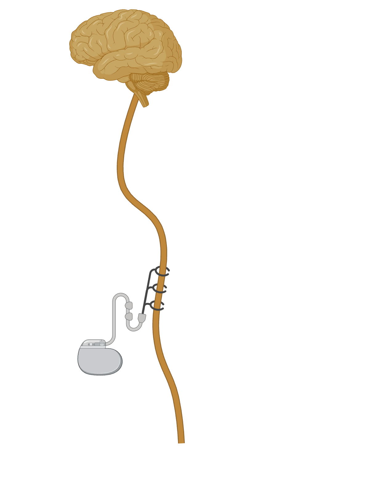Diagram of a brain and spinal cord with a medical device attached to the spinal cord.