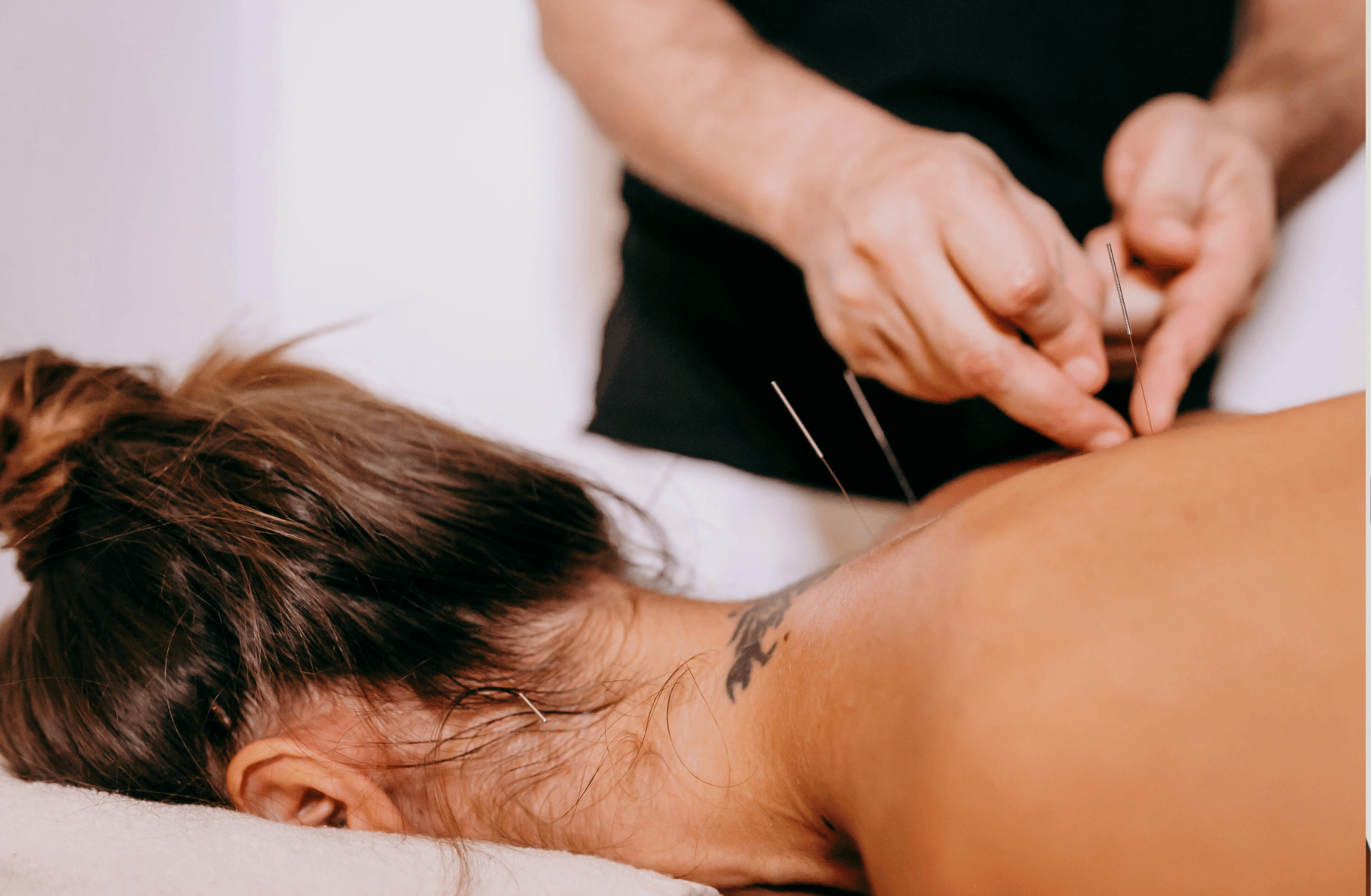 A person receiving acupuncture treatment on their upper back and shoulder area, with multiple acupuncture needles inserted into their skin.