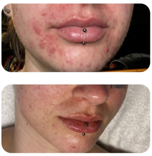 Acne Facial Results Multiple Treatments