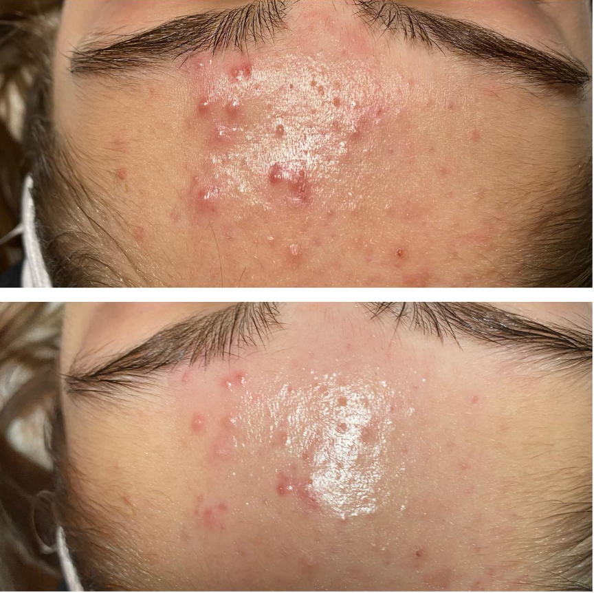Acne Facial Results Single Treatment