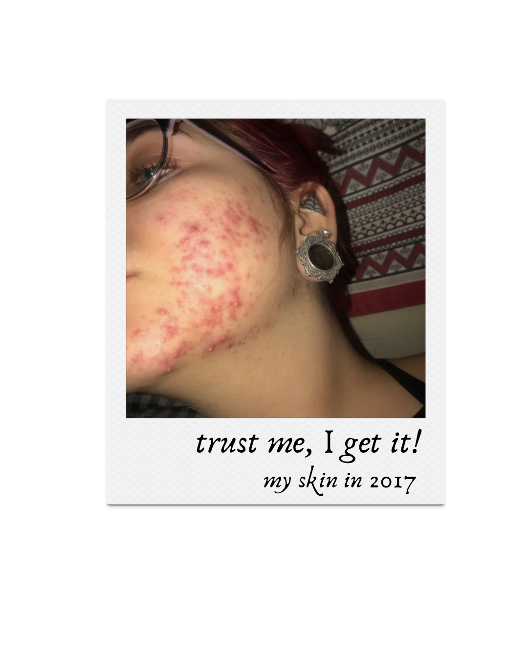 Inflamed Acne