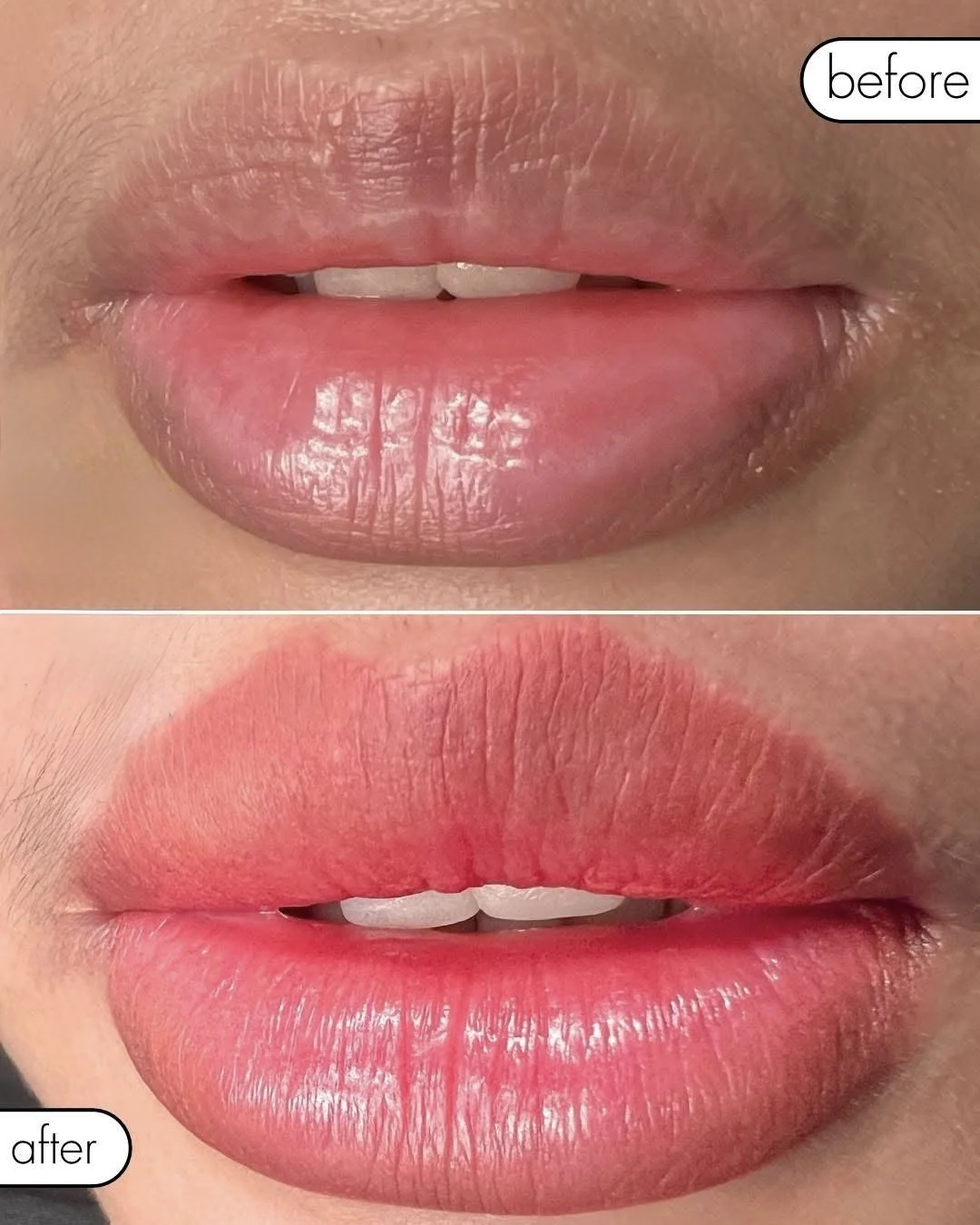 Close-up of lips before and after lip enhancement, showing fuller, smoother lips after treatment.