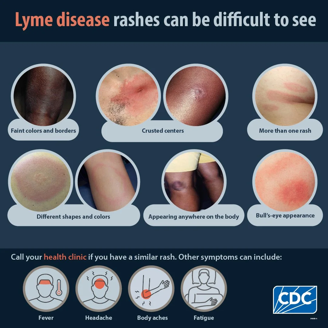 Graphic showing different appearances of Lyme disease rashes, including faint colors and borders, crusted centers, multiple rashes, different shapes and colors, occurring anywhere on the body, and bull's-eye appearance, with a note to call your health clinic if you notice similar rashes. The CDC logo is in the bottom right corner.