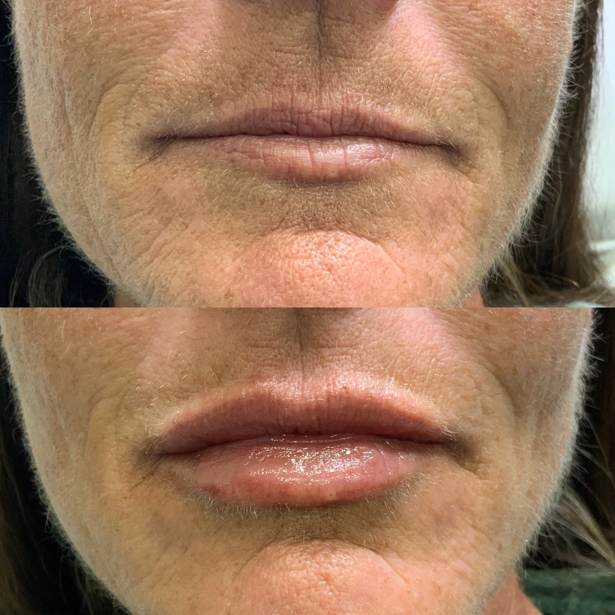 Lip Filler