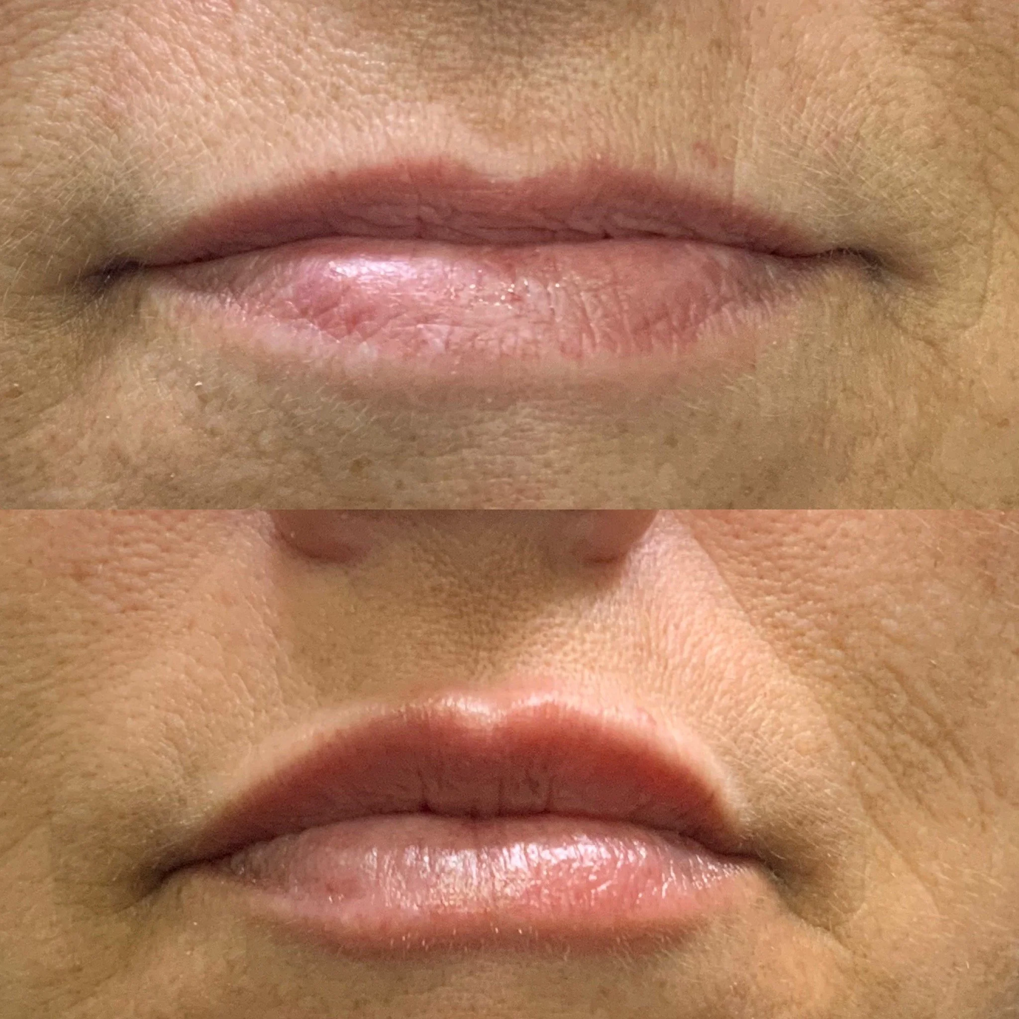 Lip Filler