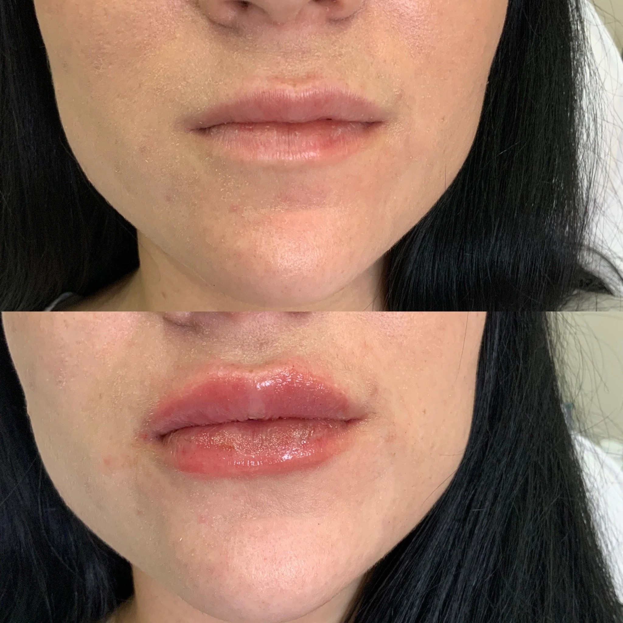 Lip FIller