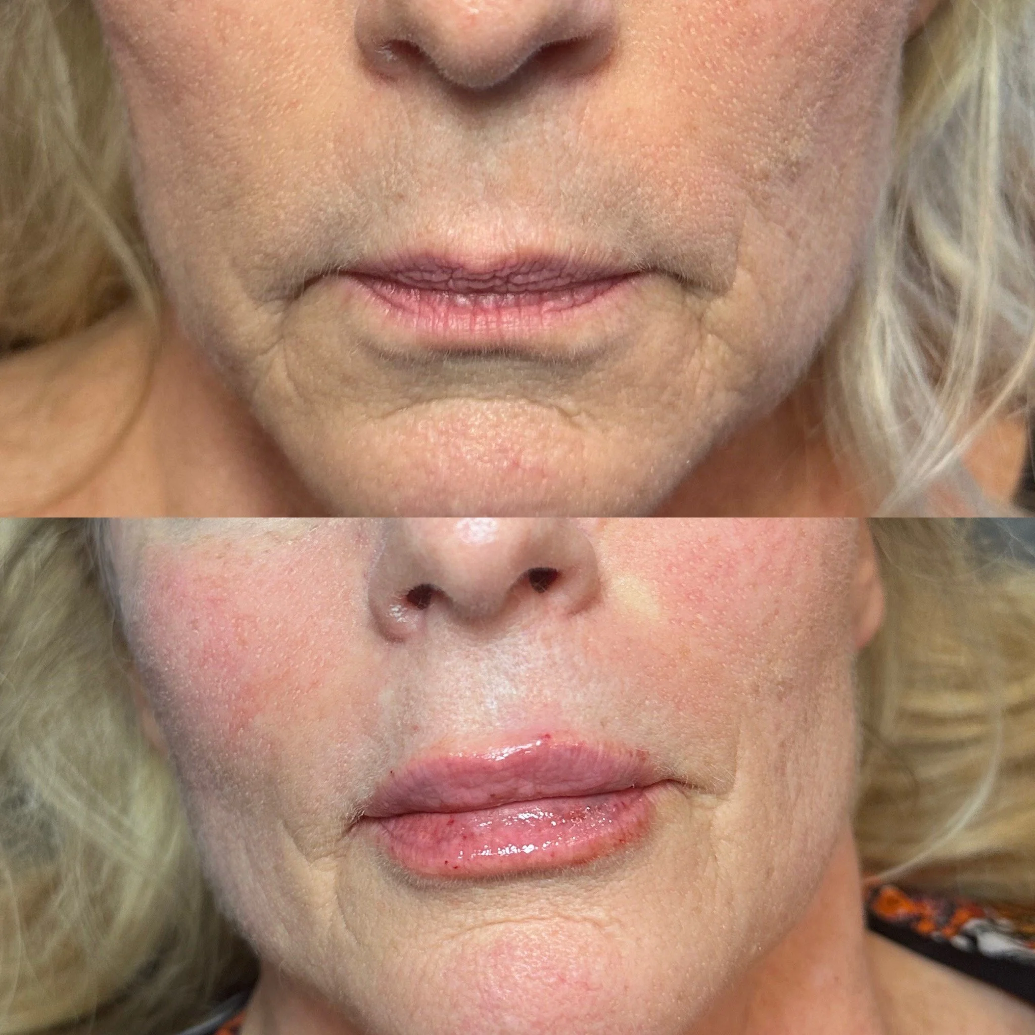 Lip Filler