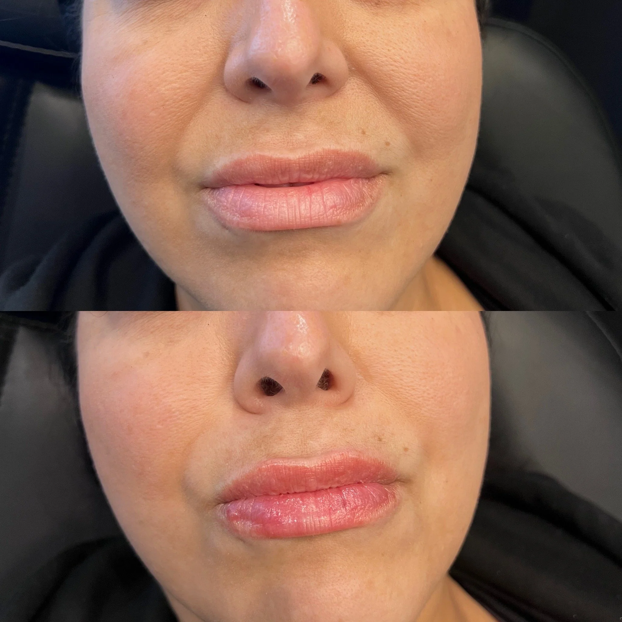 Lip Filler