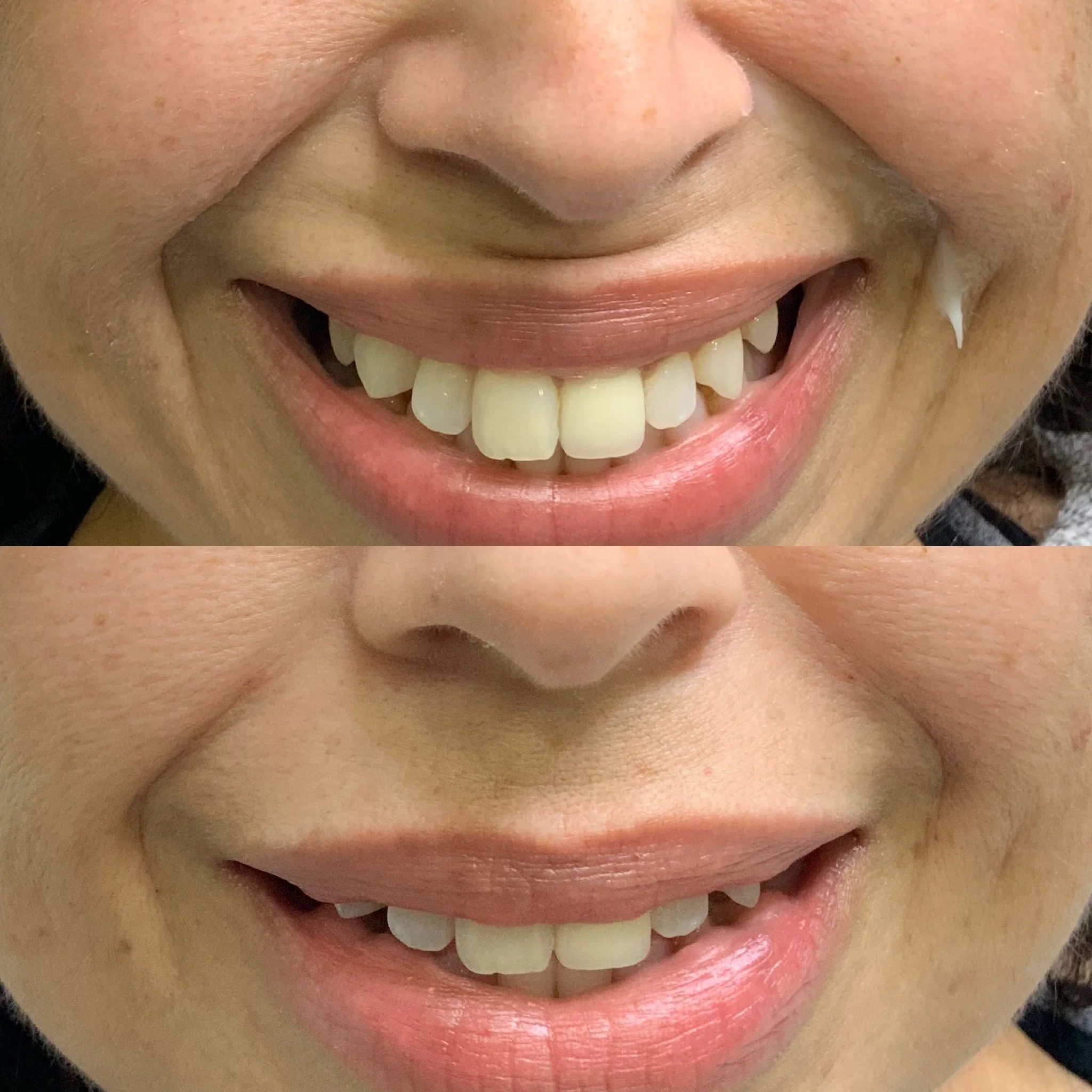 Smile Line Filler