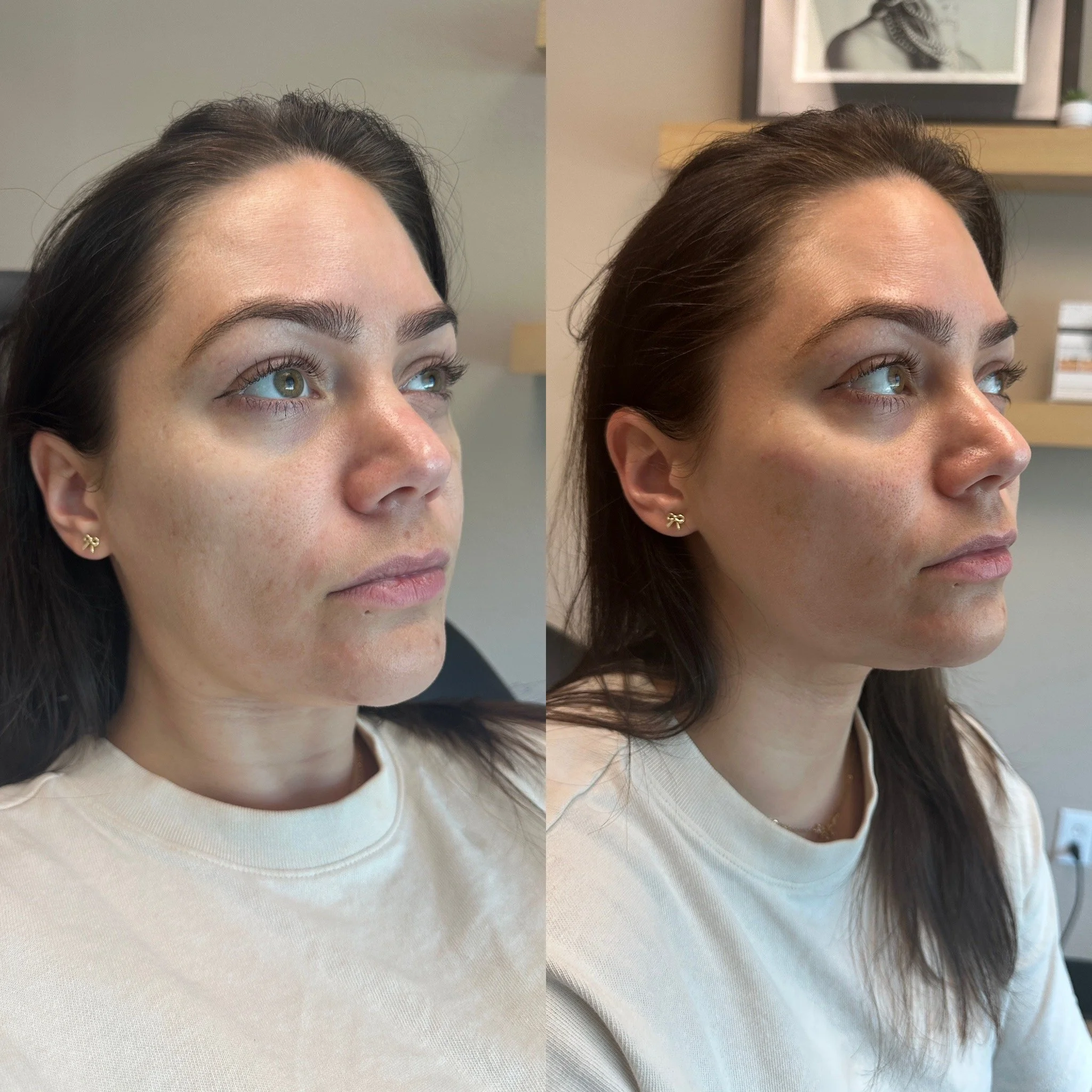 Cheek/Mid Face Filler 1 syringe