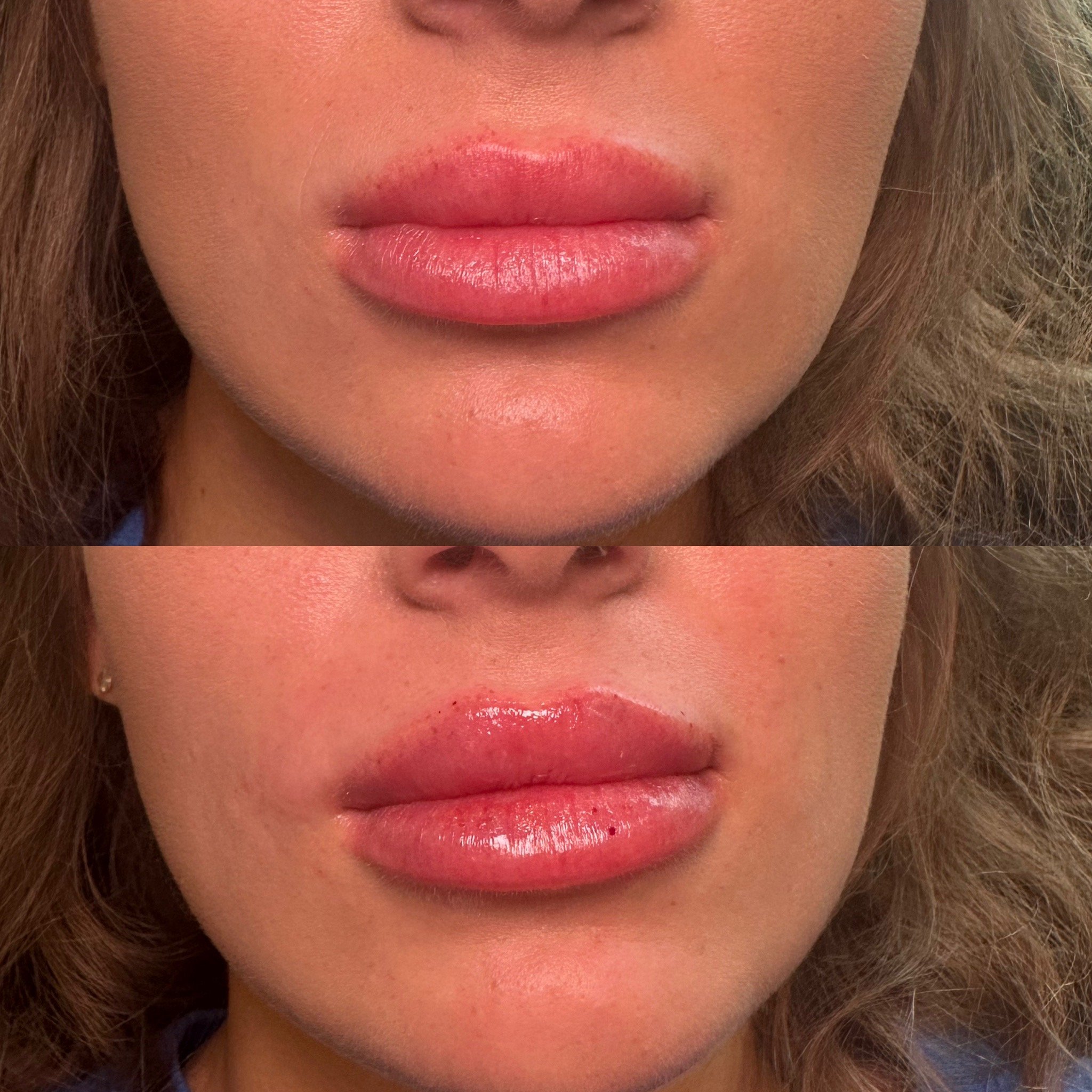 Mini Lip Filler (0.5 Syringe)