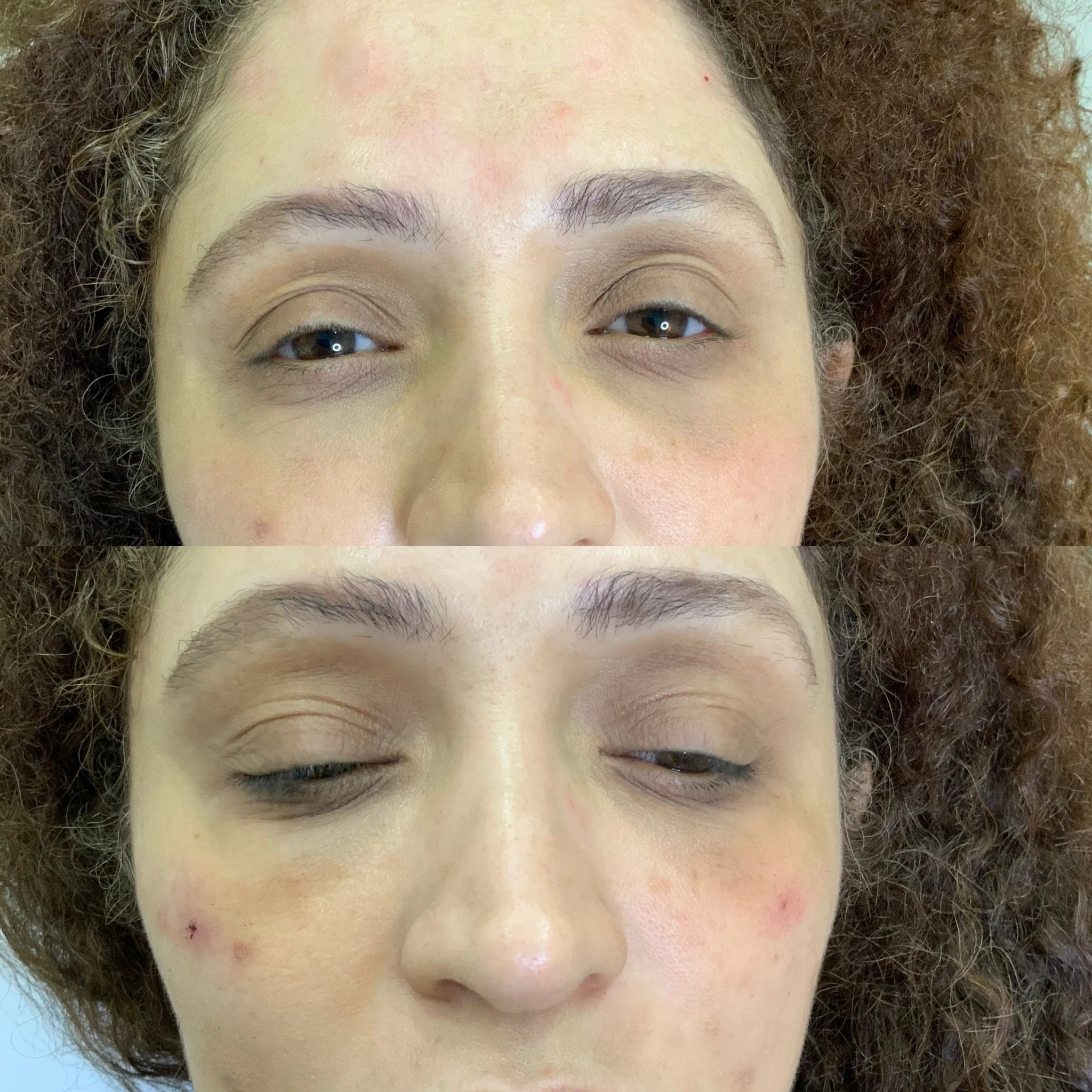 Under Eye Treatment