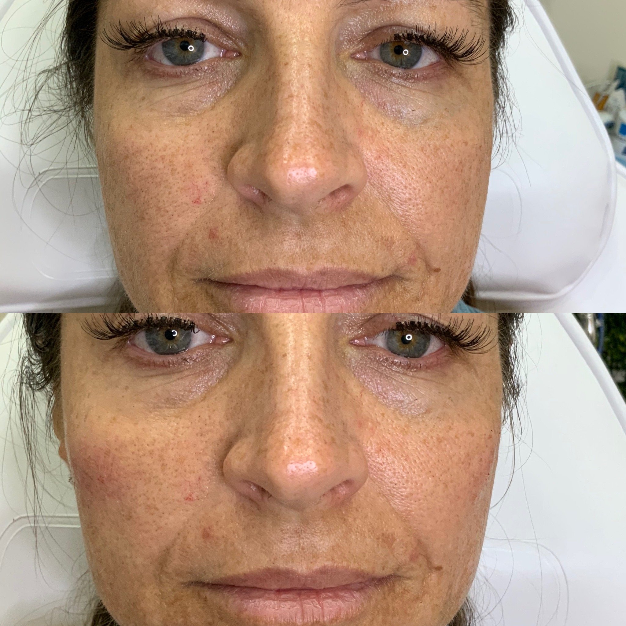 Cheek Filler