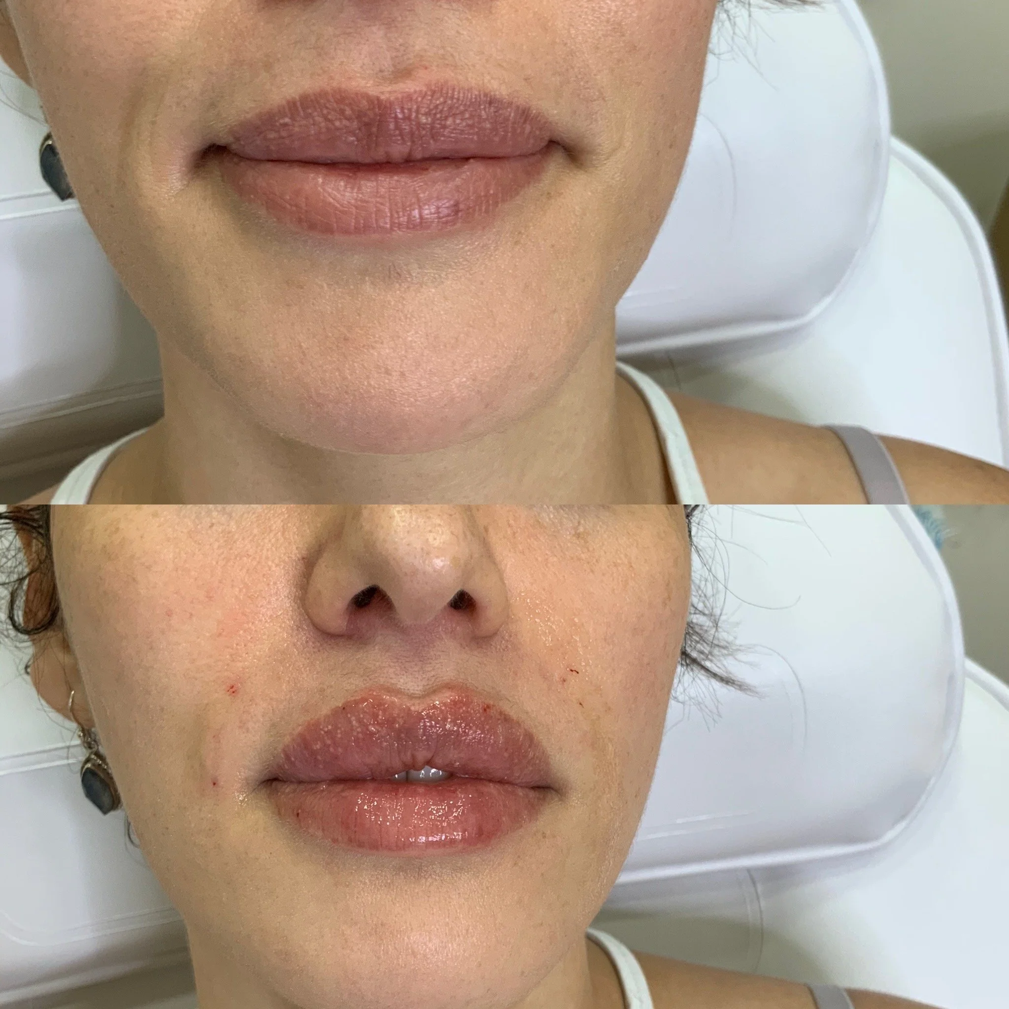 Smile line filler and Lip Filler